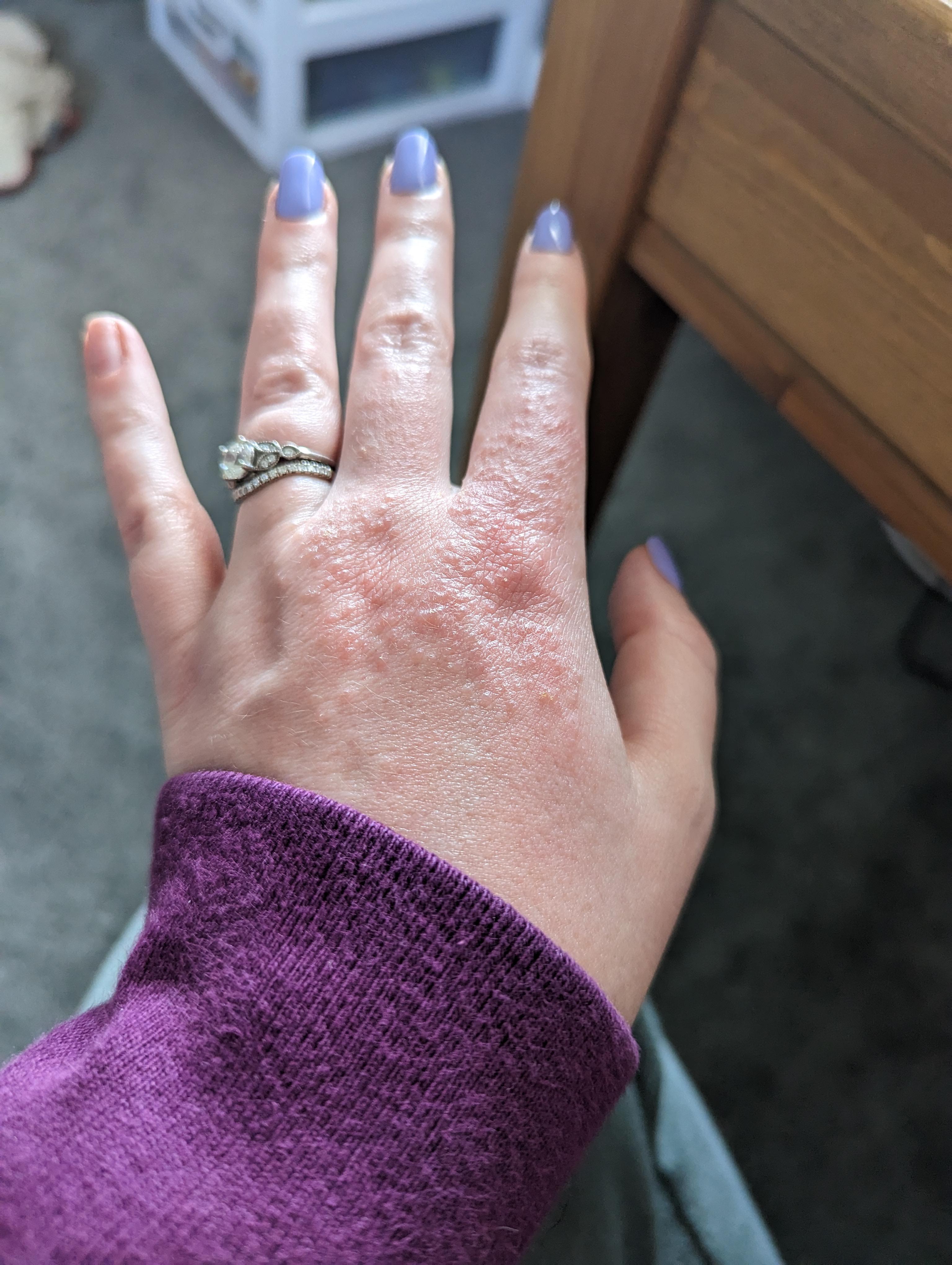 Are there any eczema "safe" hand soaps or ways to wash hands? r/eczema
