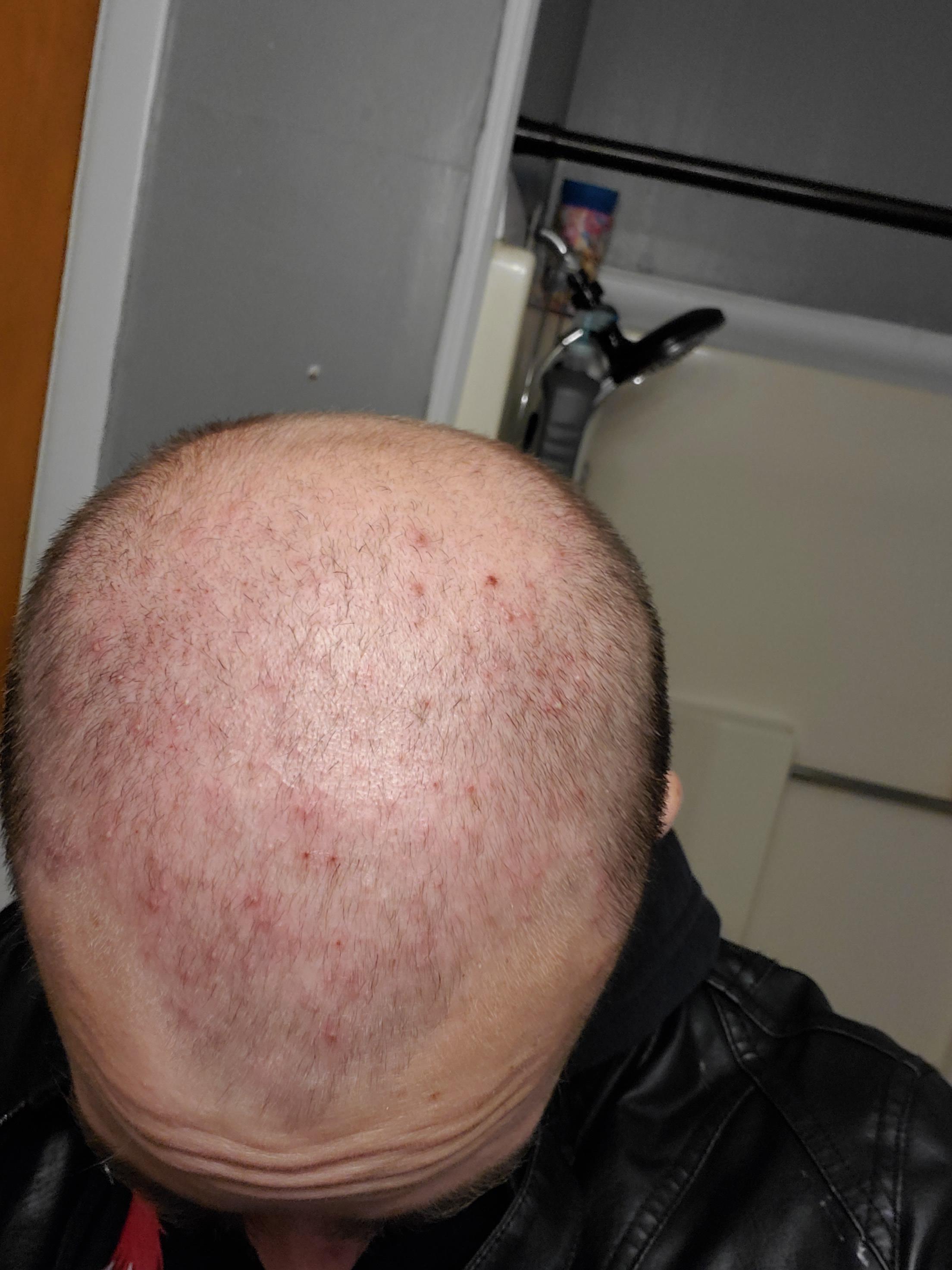 Always had pimples on my scalp. Now you can see all of them r/popping