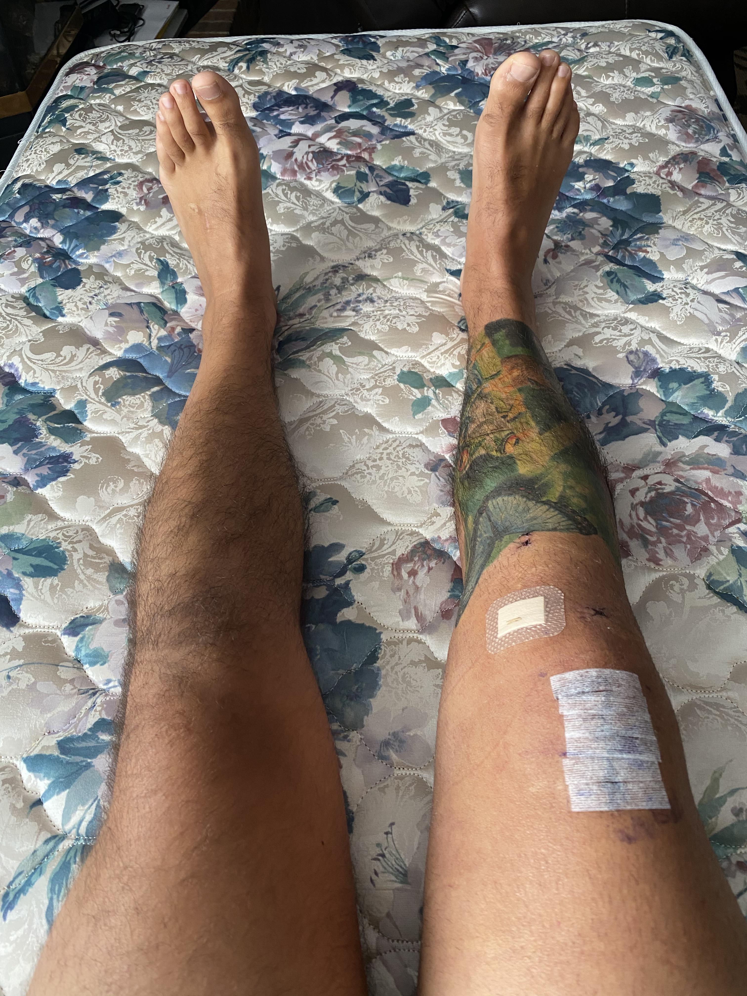 2 weeks post op today. Started PT yesterday. Doing I’m home exercises