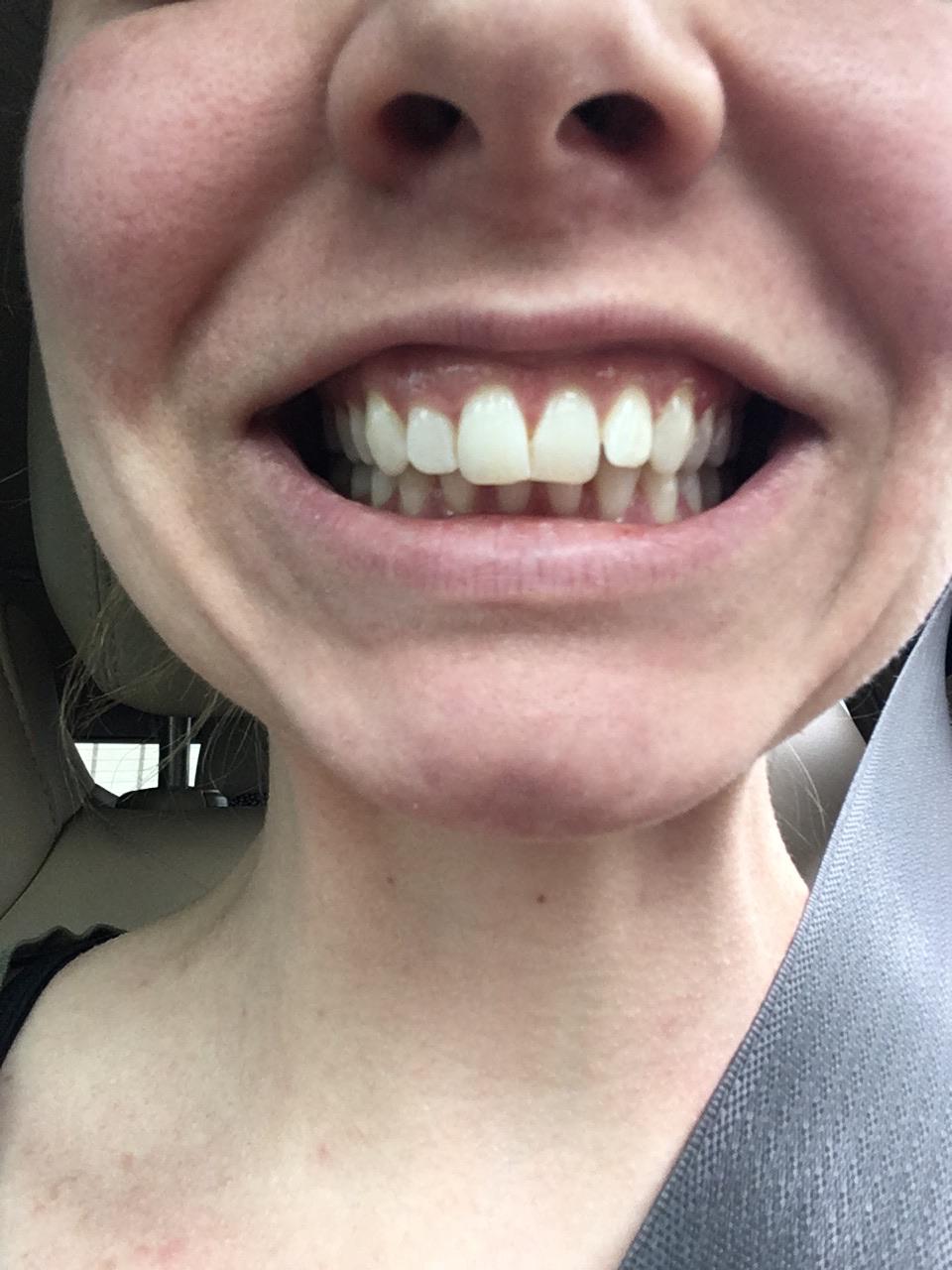 How will overbite correction change the appearance of the rest of my