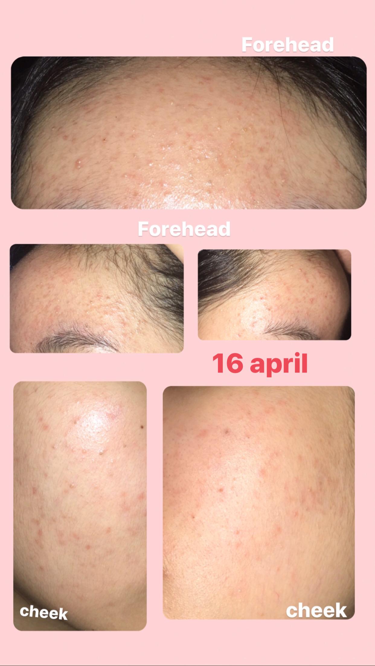 I’ve been dealing with fungal acne for a long time. Have