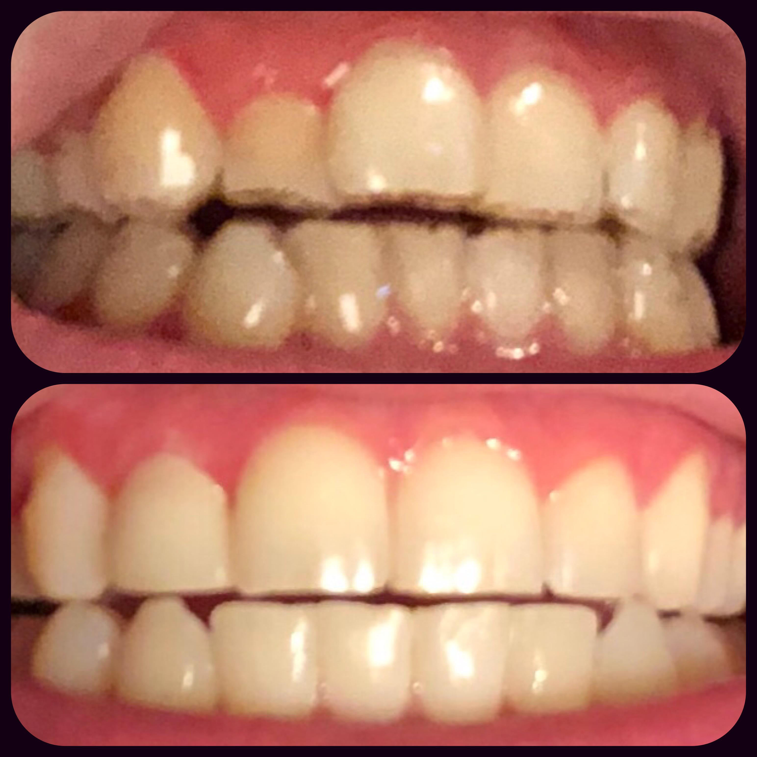 30 Trays Later (and before whitening treatments) r/Invisalign
