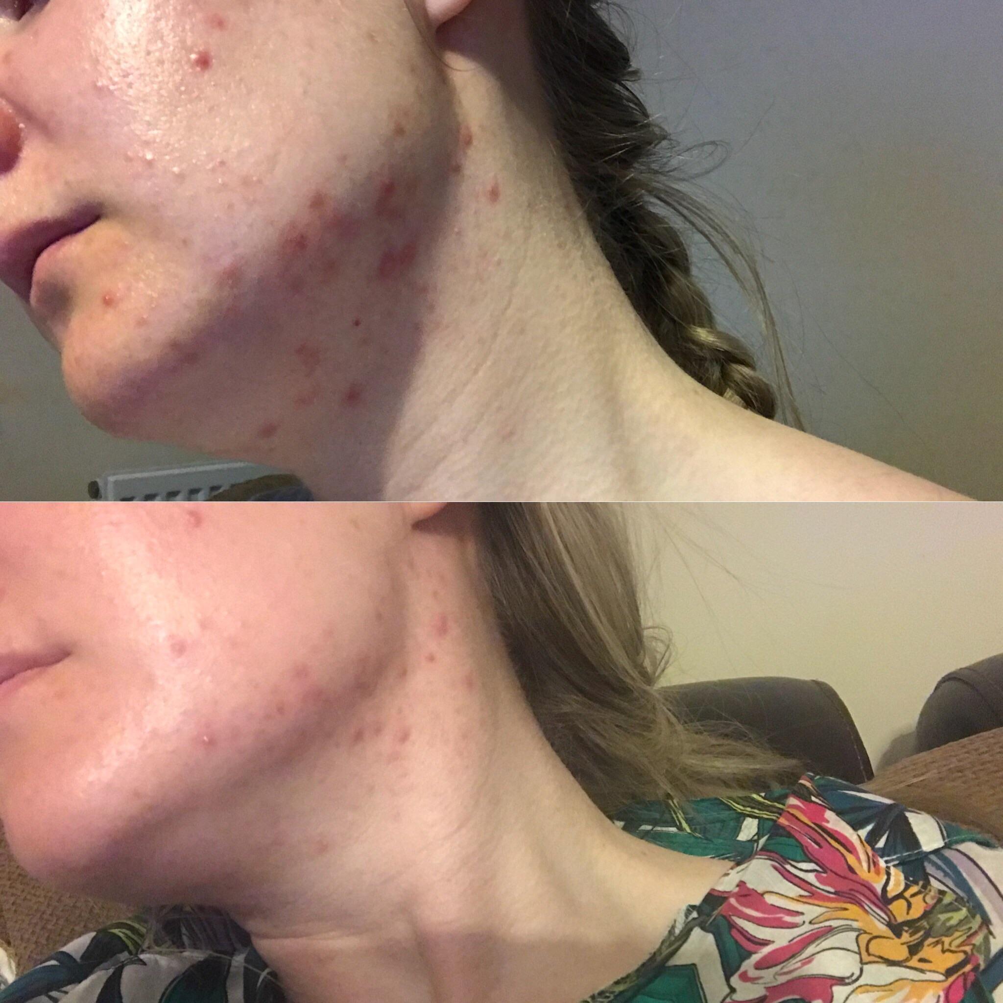 [before & after] clearing up neck acne now to tackle