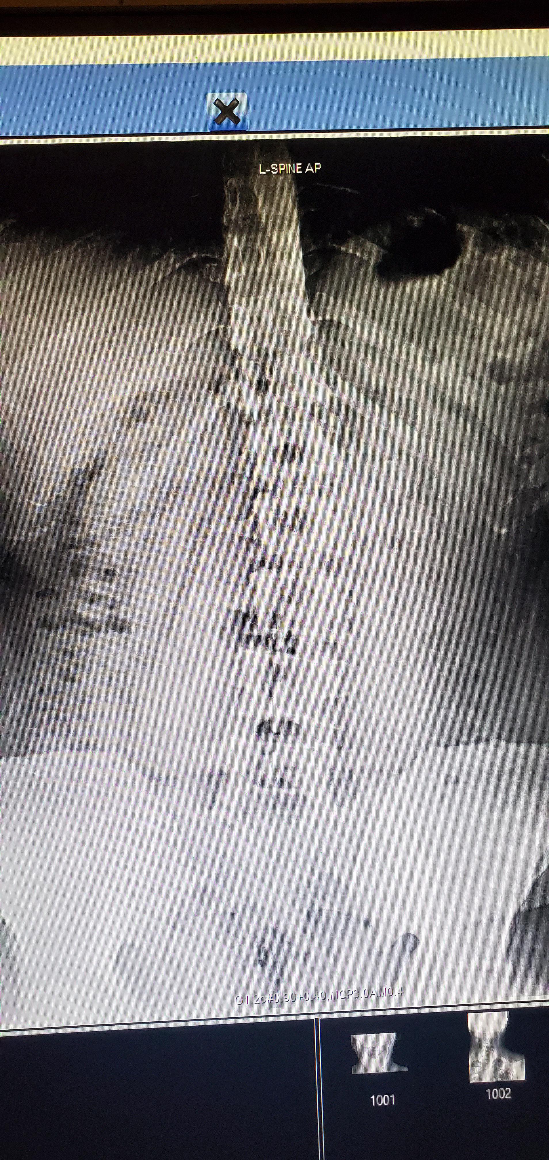 Got into a car wreck now I have a scoliosis injury and can't work. r