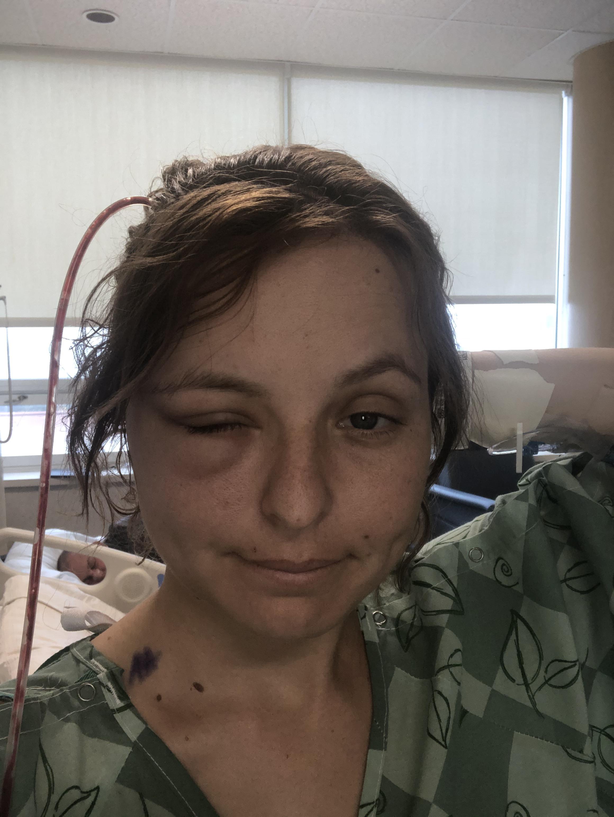 Brain Aneurysm Scar How are cerebral aneurysms diagnosed? Insight from Leticia