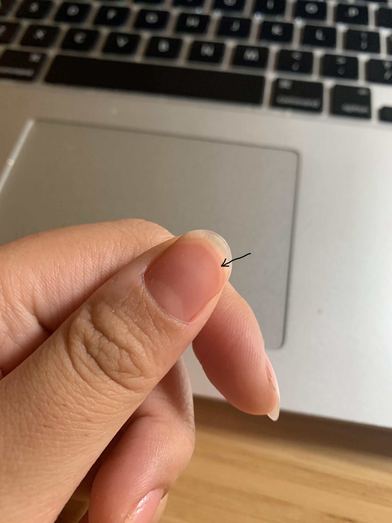 is this little line in the middle , my nail bed reattaching? r/nailbiting