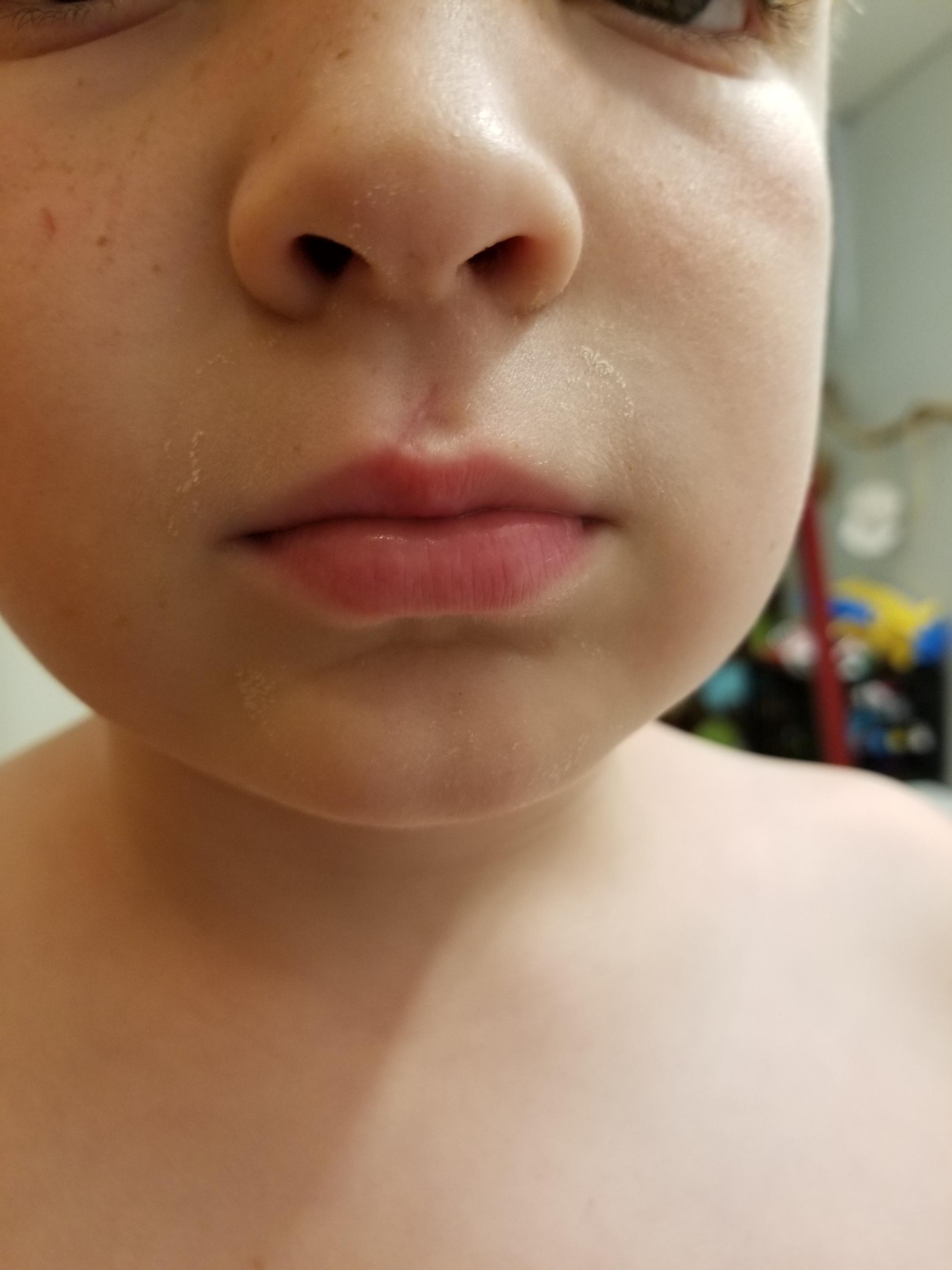 [Skin Concern] My 7 year old had stitches after a bike accident; what
