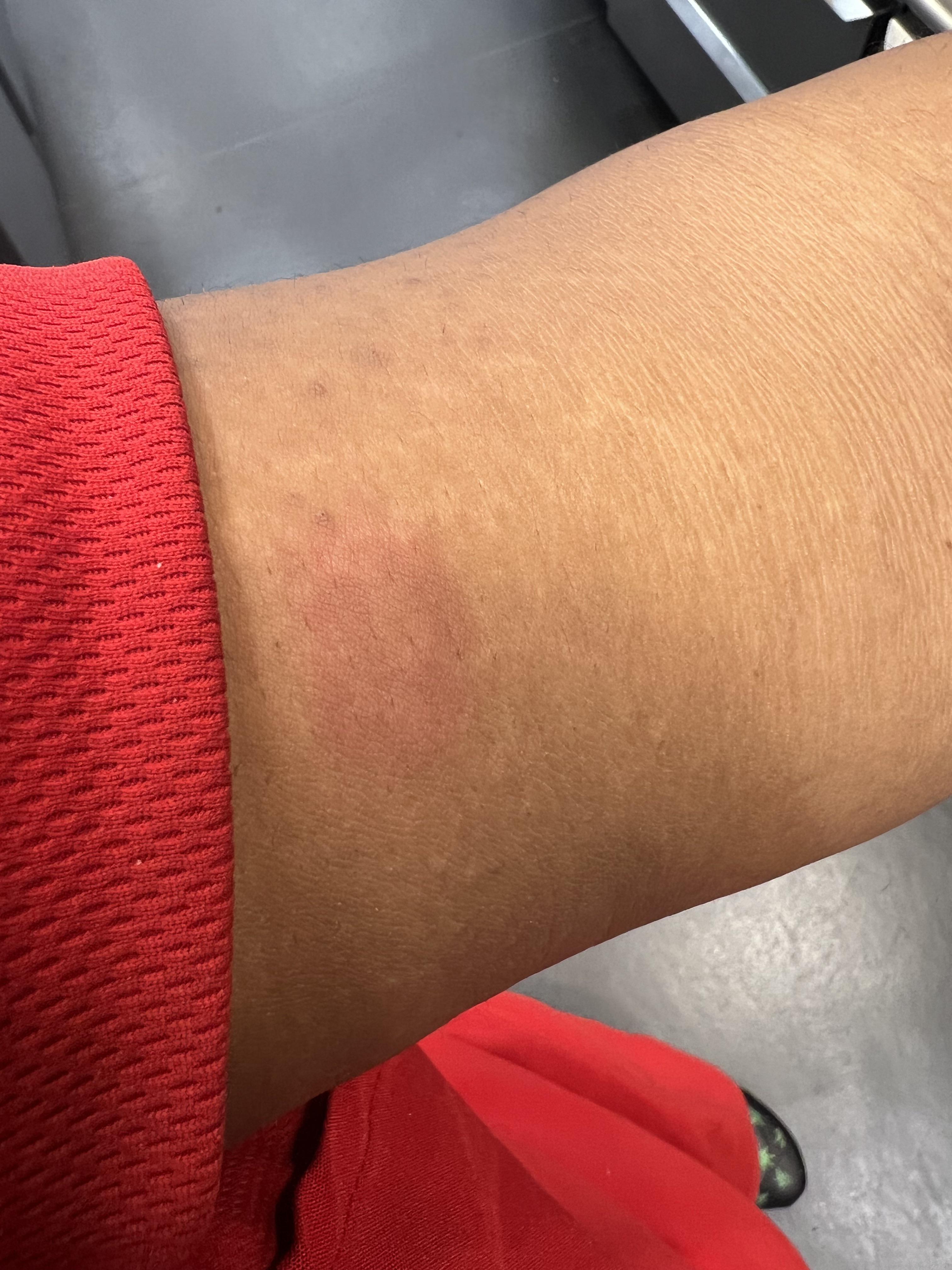 About 3 days ago I seen this on my arm and started putting neosporin on it I don’t know if it’s