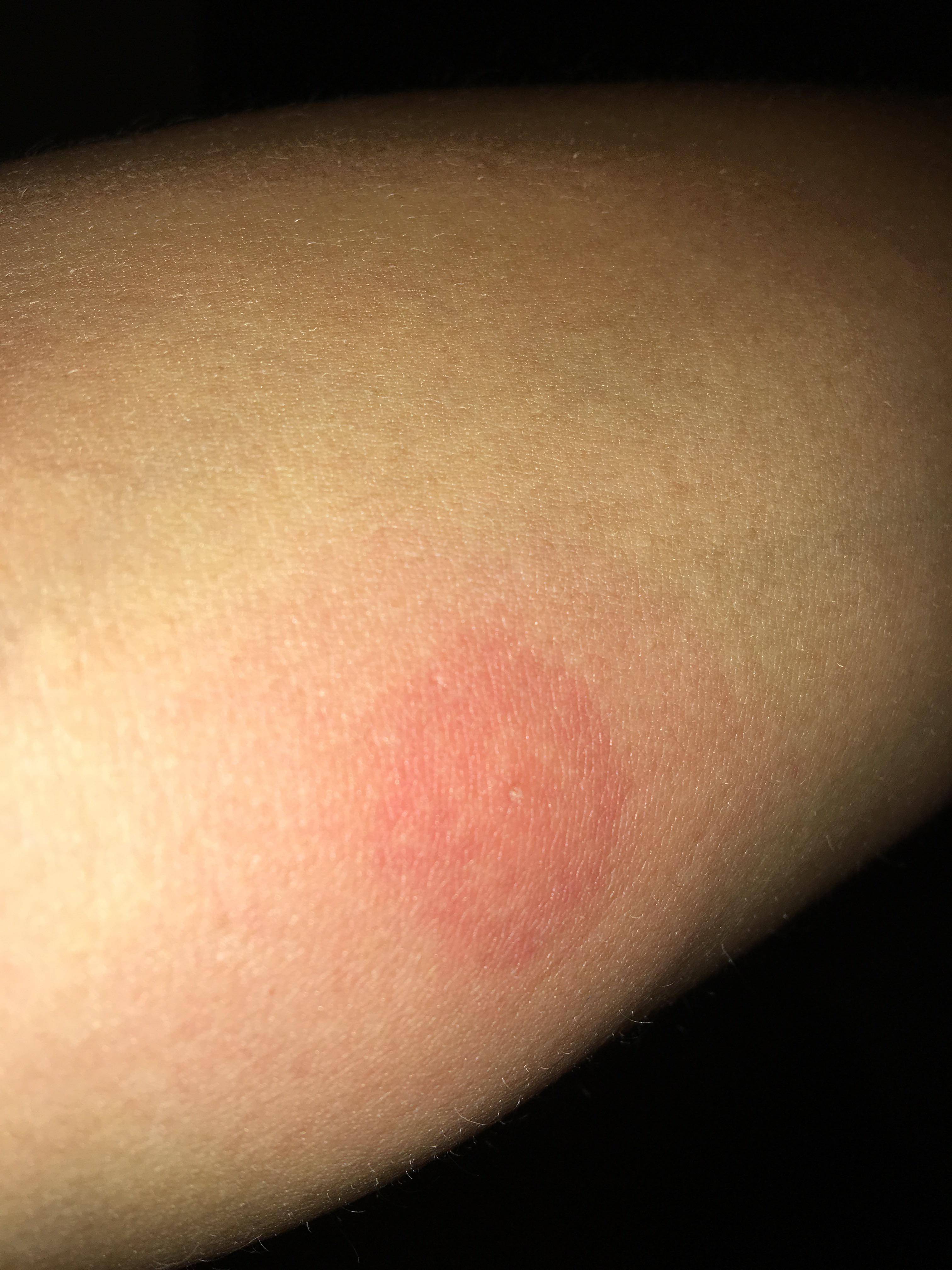 Can anyone tell me if this is a spider bite? Is so what should I do for