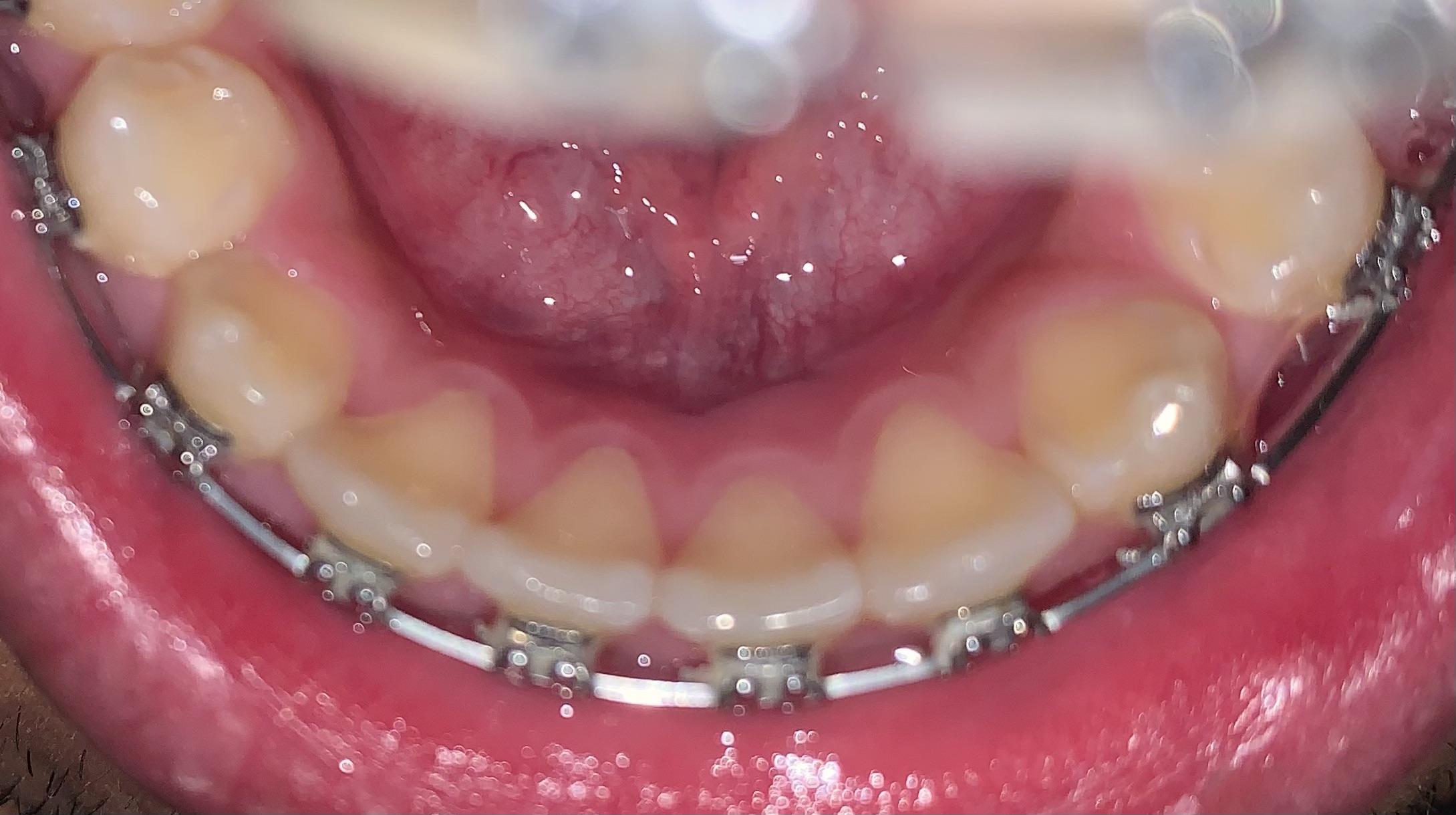 Are my gums behind bottom teeth receding? r/PeriodontalDisease