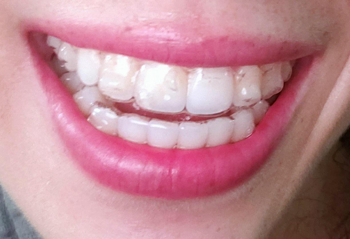 Although its not invisible, I actually don't mind how my mouth looks