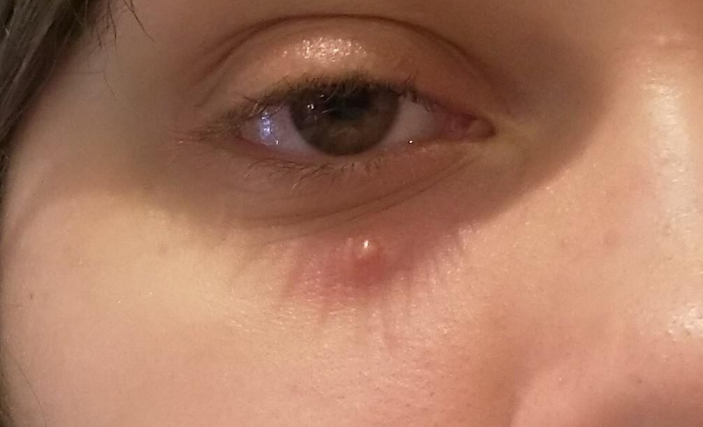 I've had this zit(?) On my face for a while, wasn't a