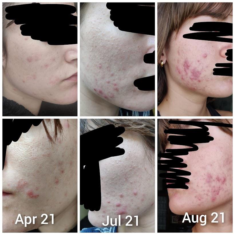 4 months on Spironolactone and it keeps getting worse HELP!!! r/acne