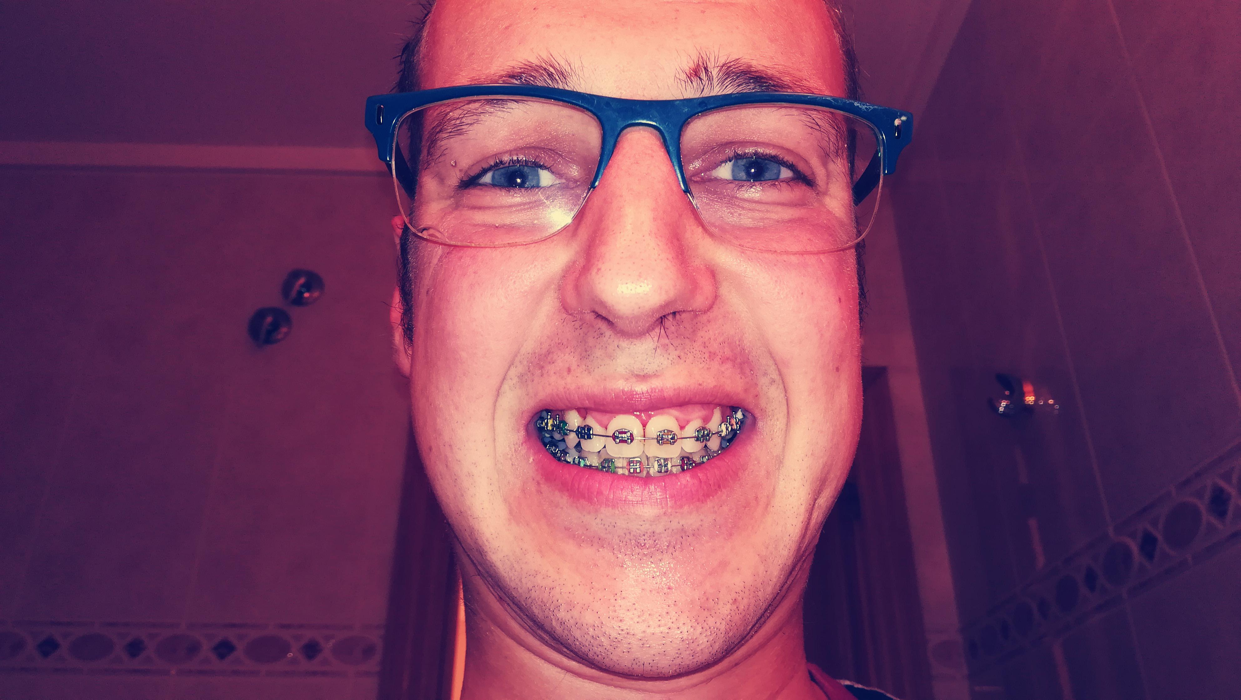 Hi. I got braces 2 years ago. This is my braces photo. Anyone speaks