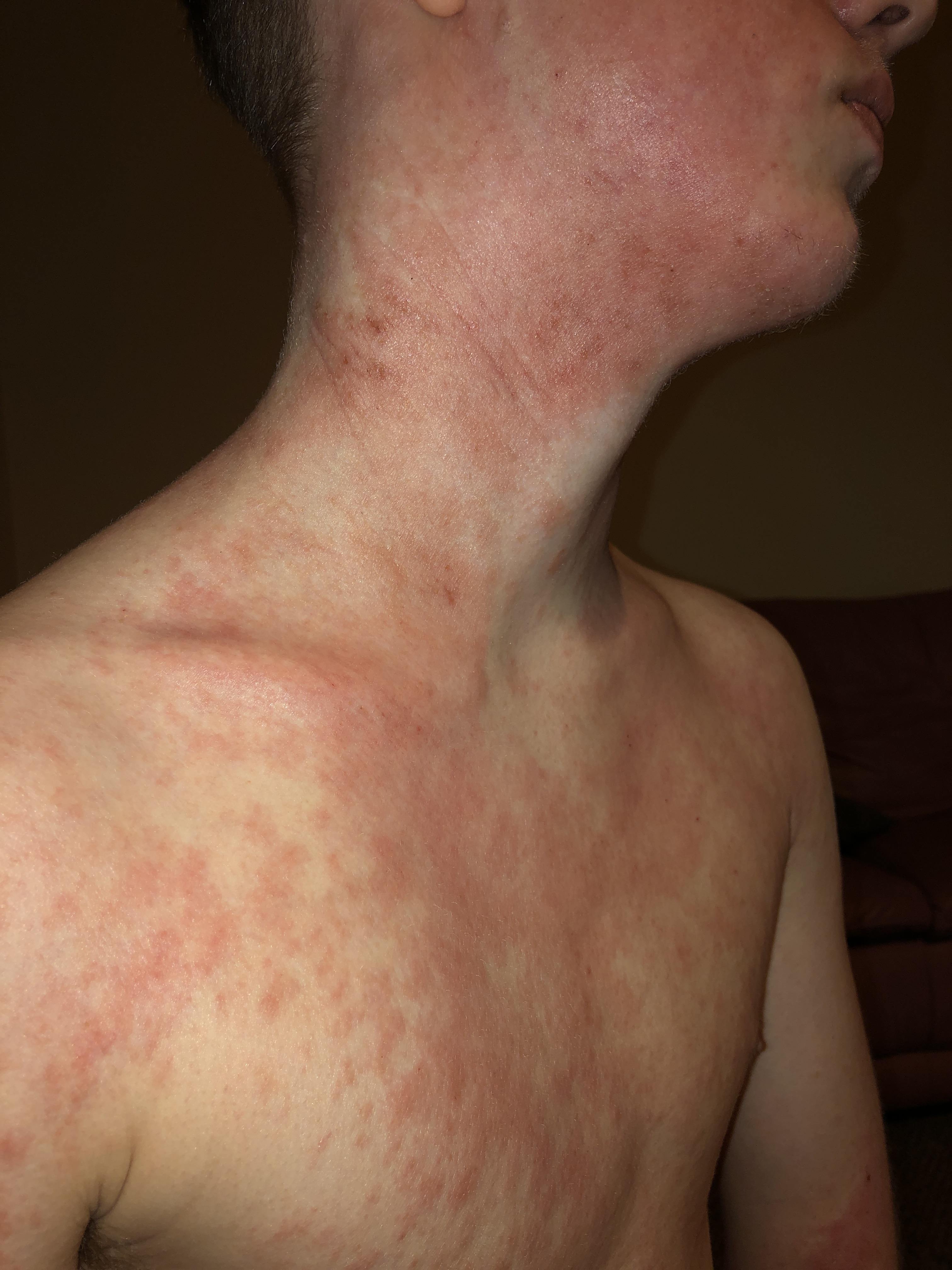 Please help, flared up probably due to being allergic to hay/horses which I am working with, I’m