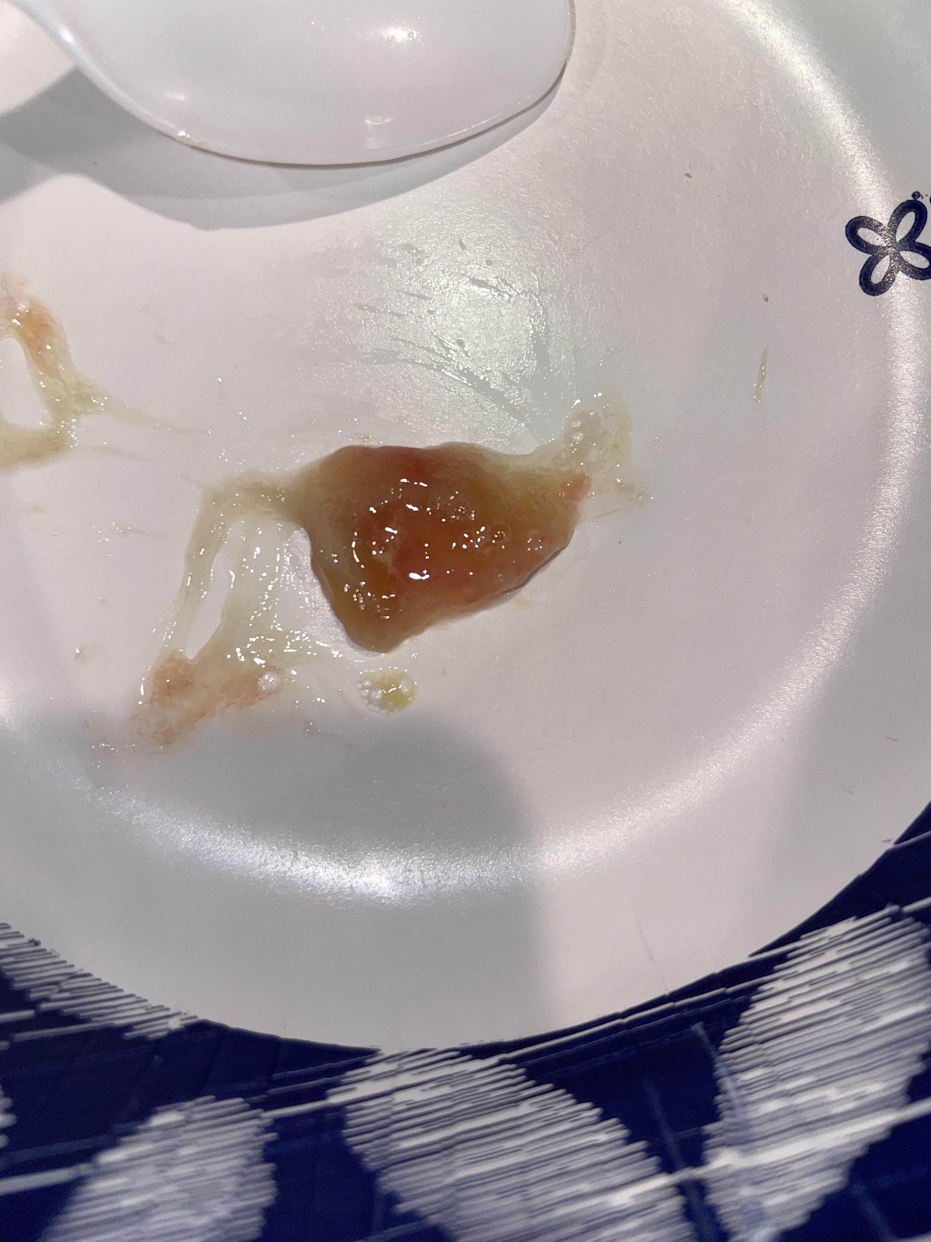 Coughed this up after getting over an infection that gave me fever for