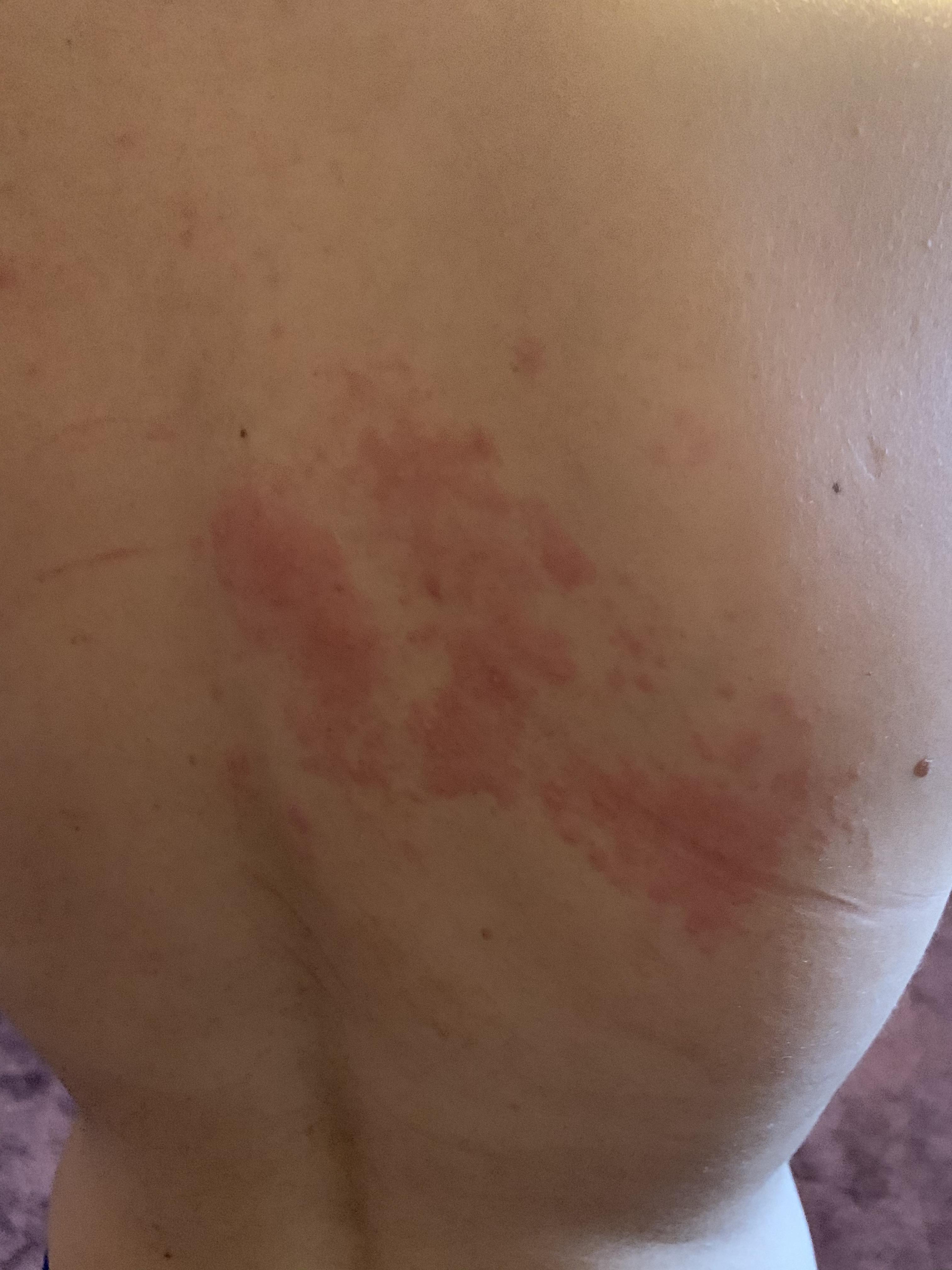 Turns out you can get shingles in your 30’s if you’re