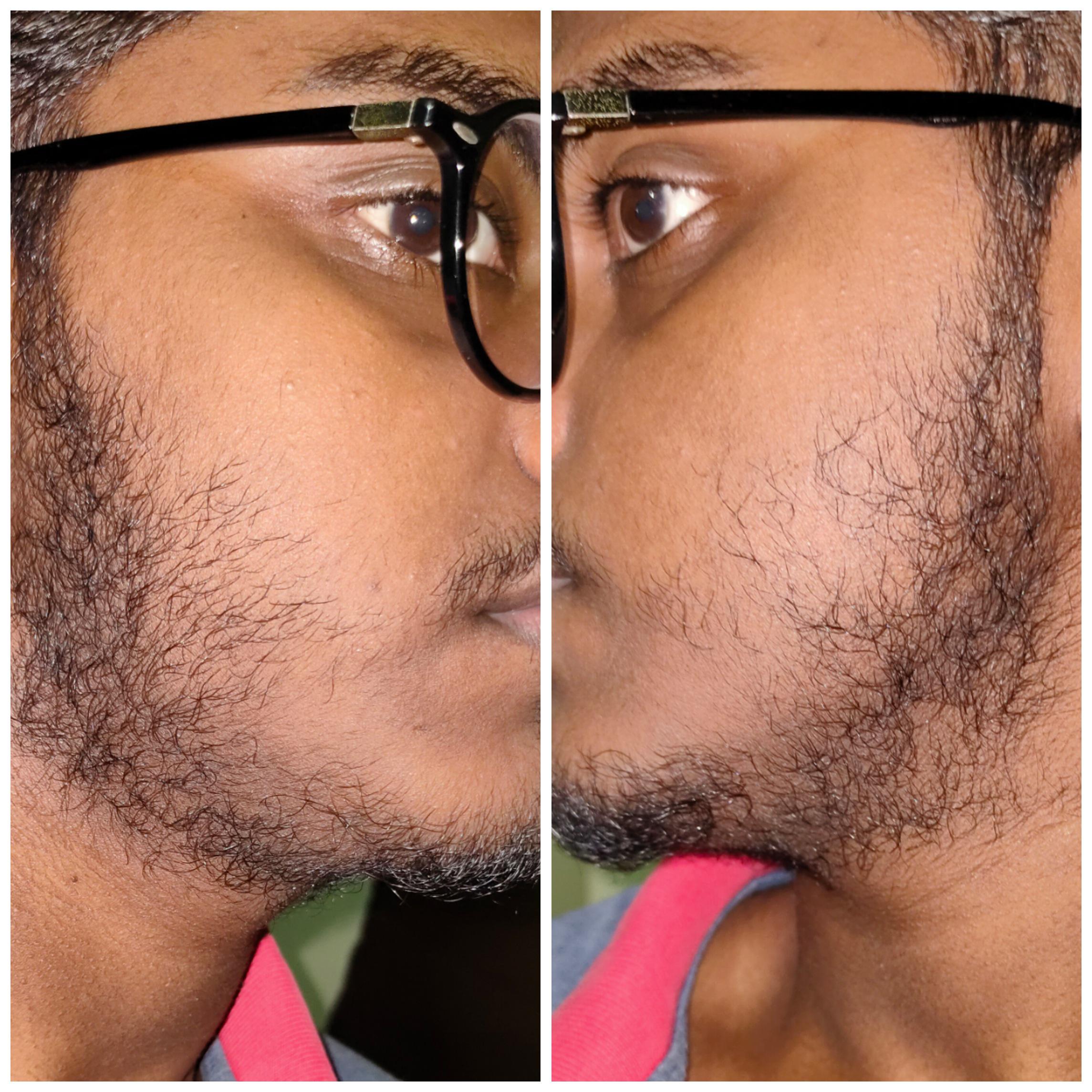 One Month on Minoxidil (check the vellus hairs on the chin) r/Minoxbeards
