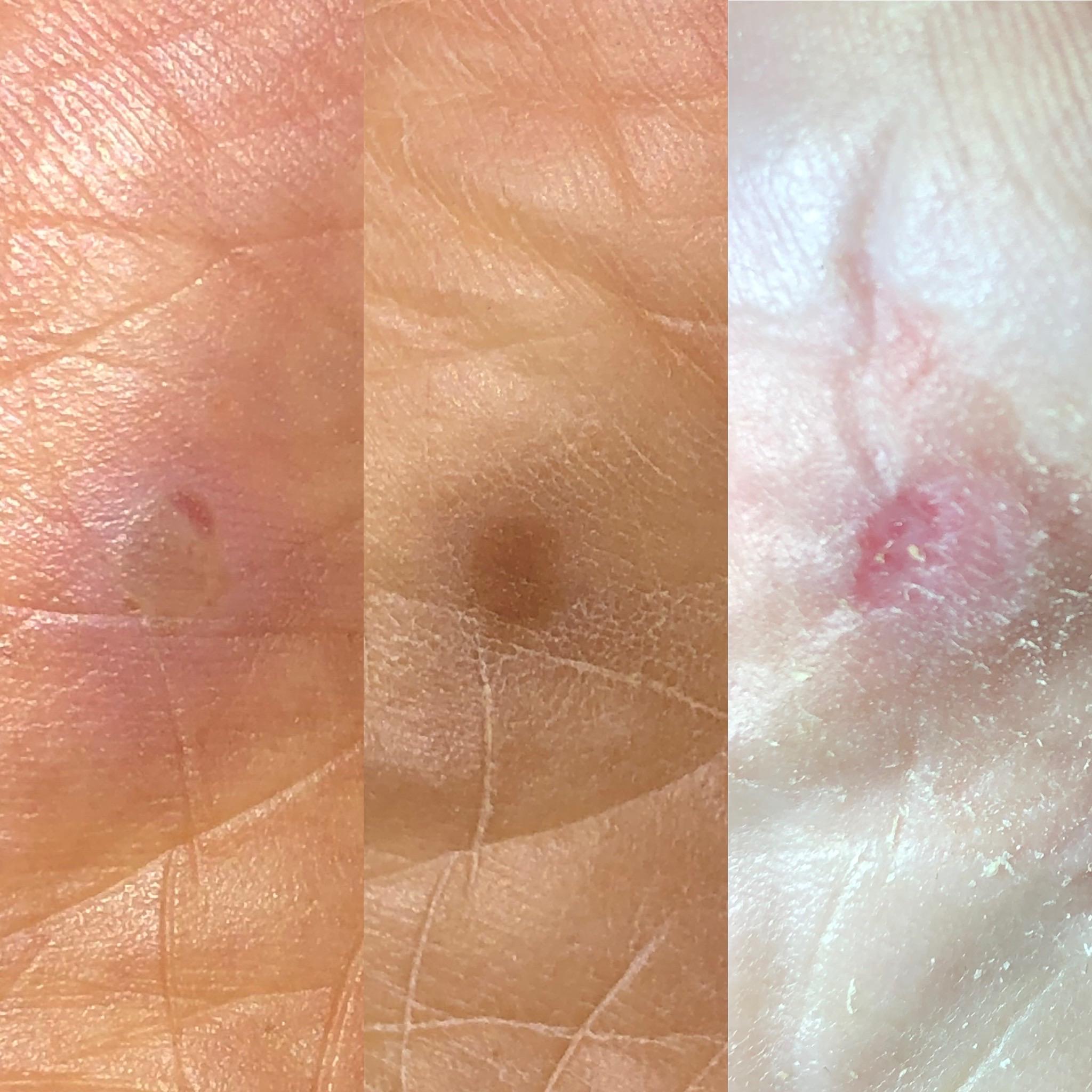 I started treating this on bottom of my foot starting Jan 8. I got more