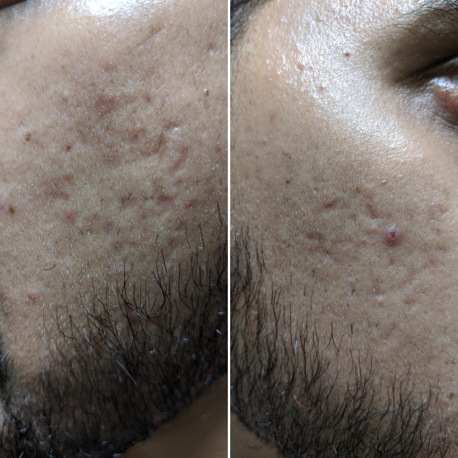 Can I please get some help with these scars? Have been using Benzoyl