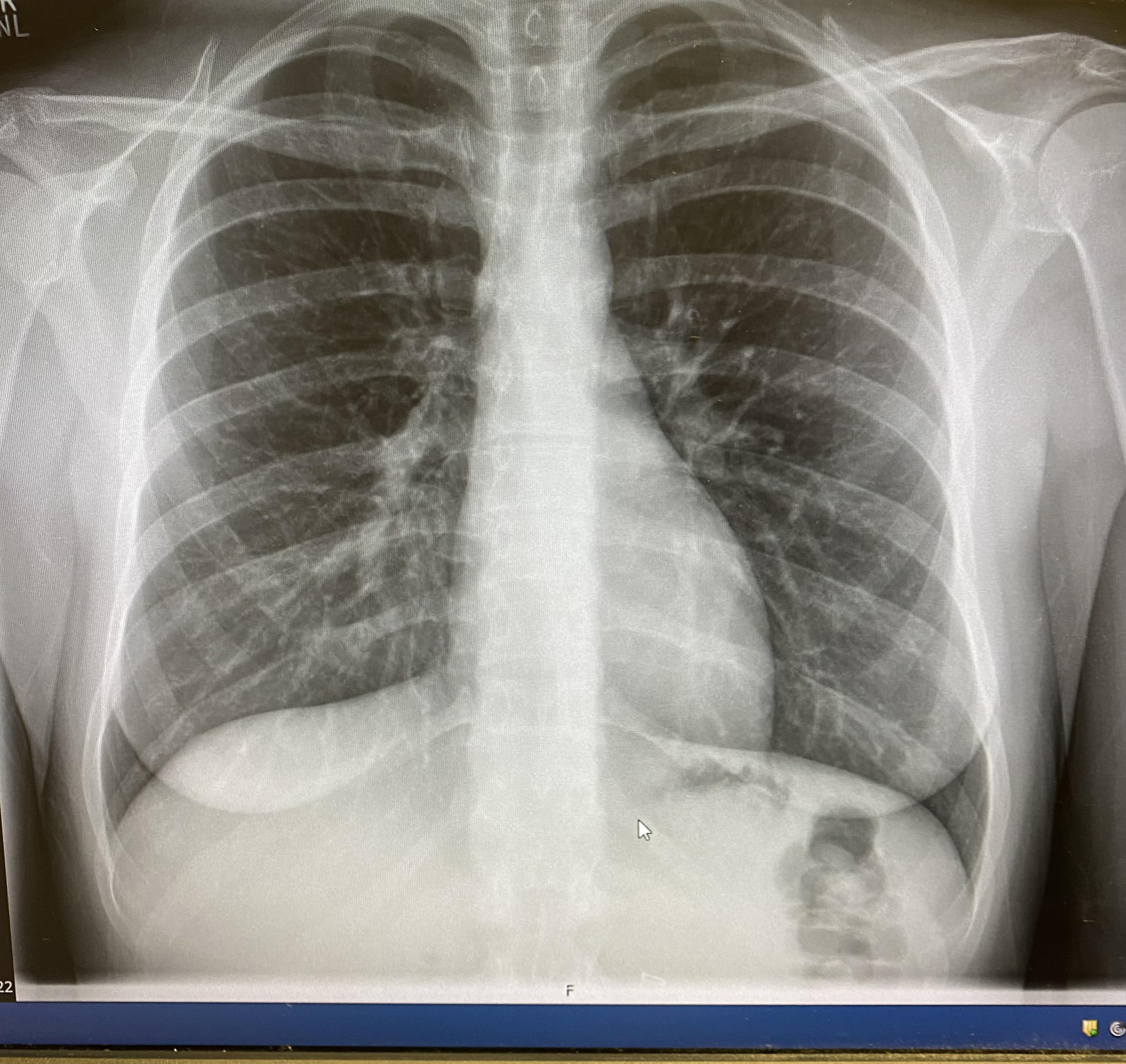 Accidentally swallowed my nose ring, they just caught it in this image