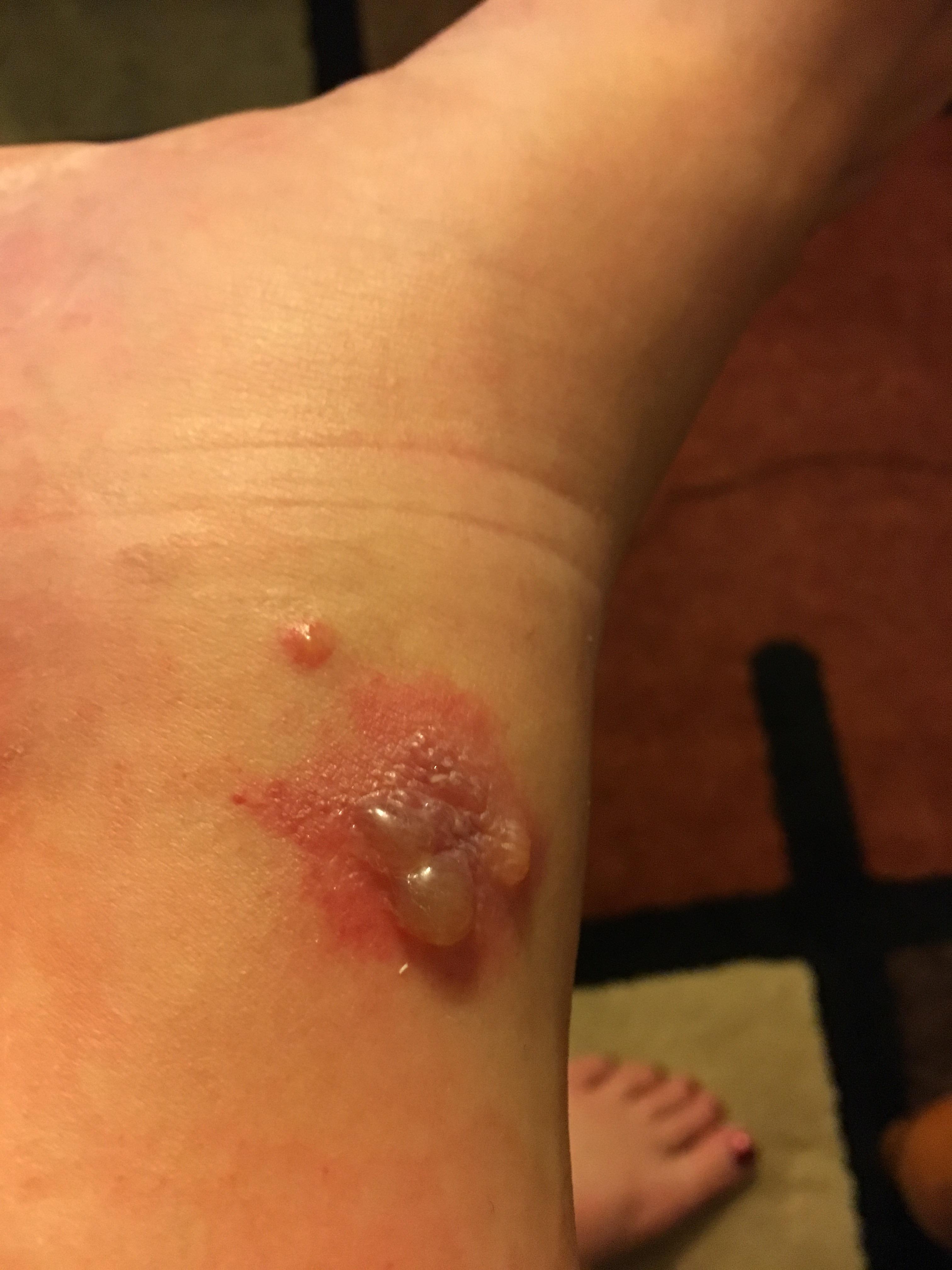 I don't react well to bed bug bites. popping