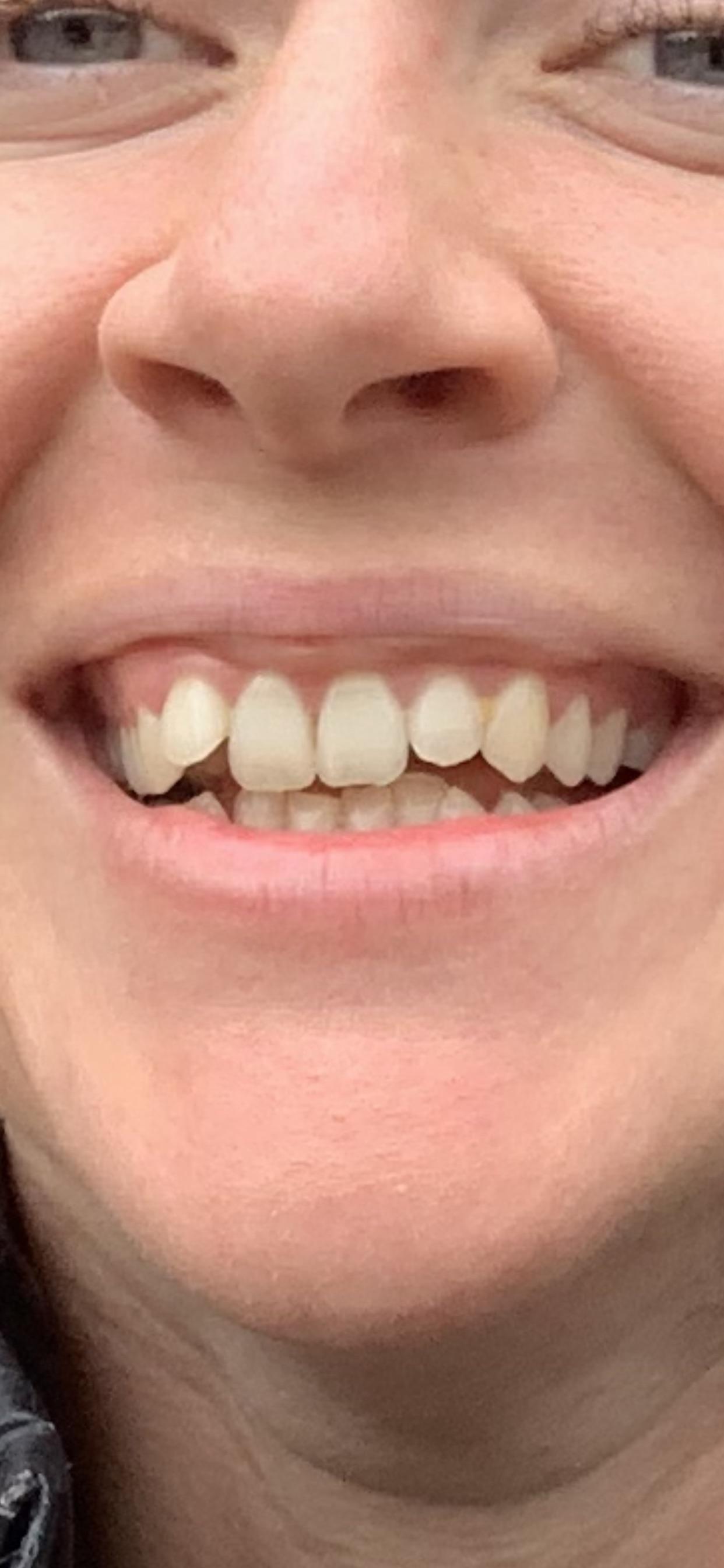 Frequently Asked Questions Invisalign