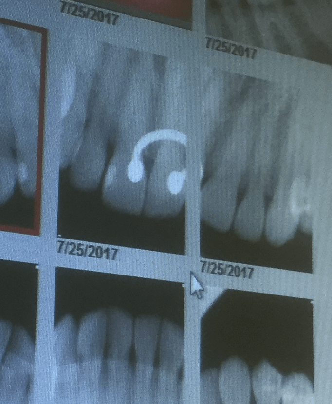 Septum piercing in Xrays at the dentist r/mildlyinteresting