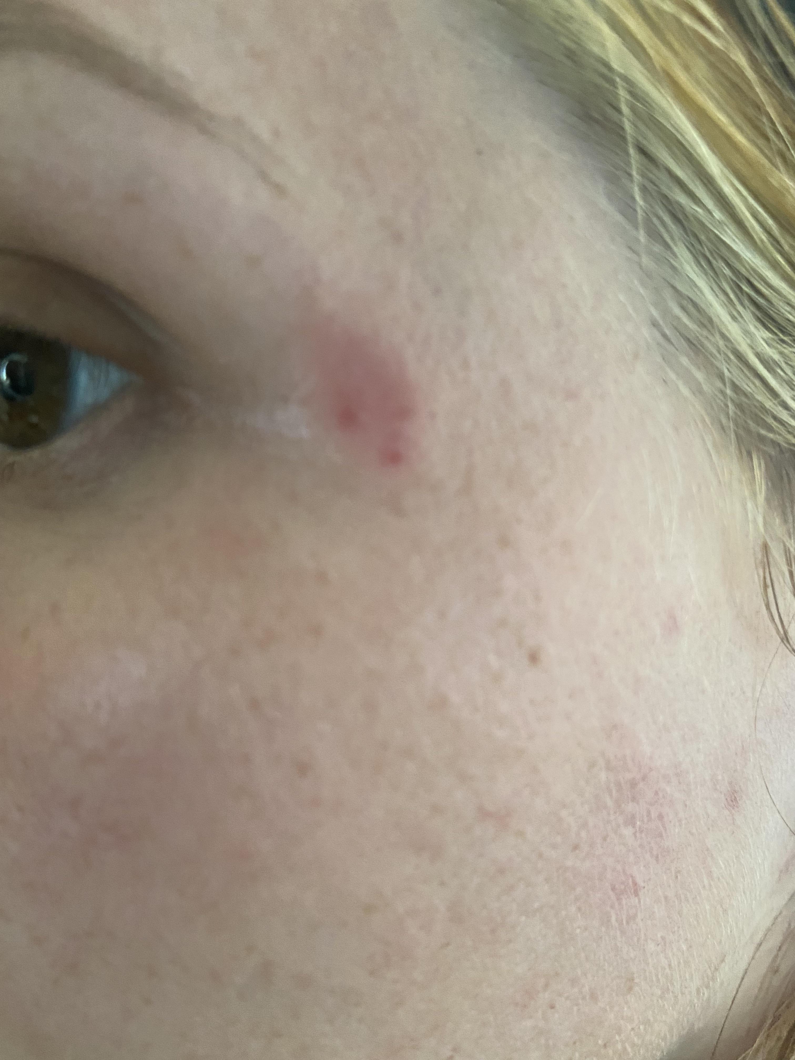 Itchy/flaky spot on face that won’t go away. r/Dermatology