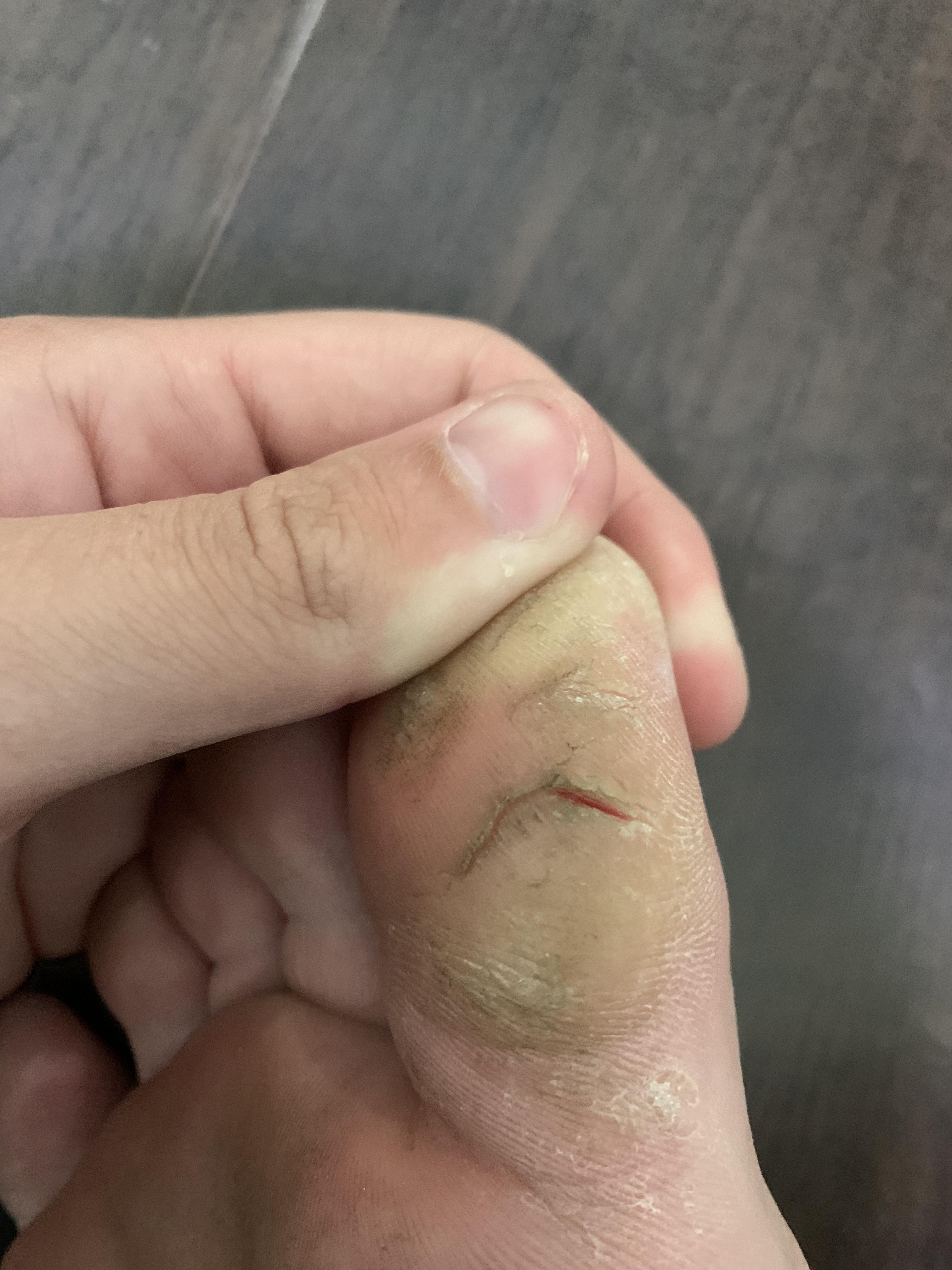 Deep crack in callus on big toe, very painful to walk on and looks