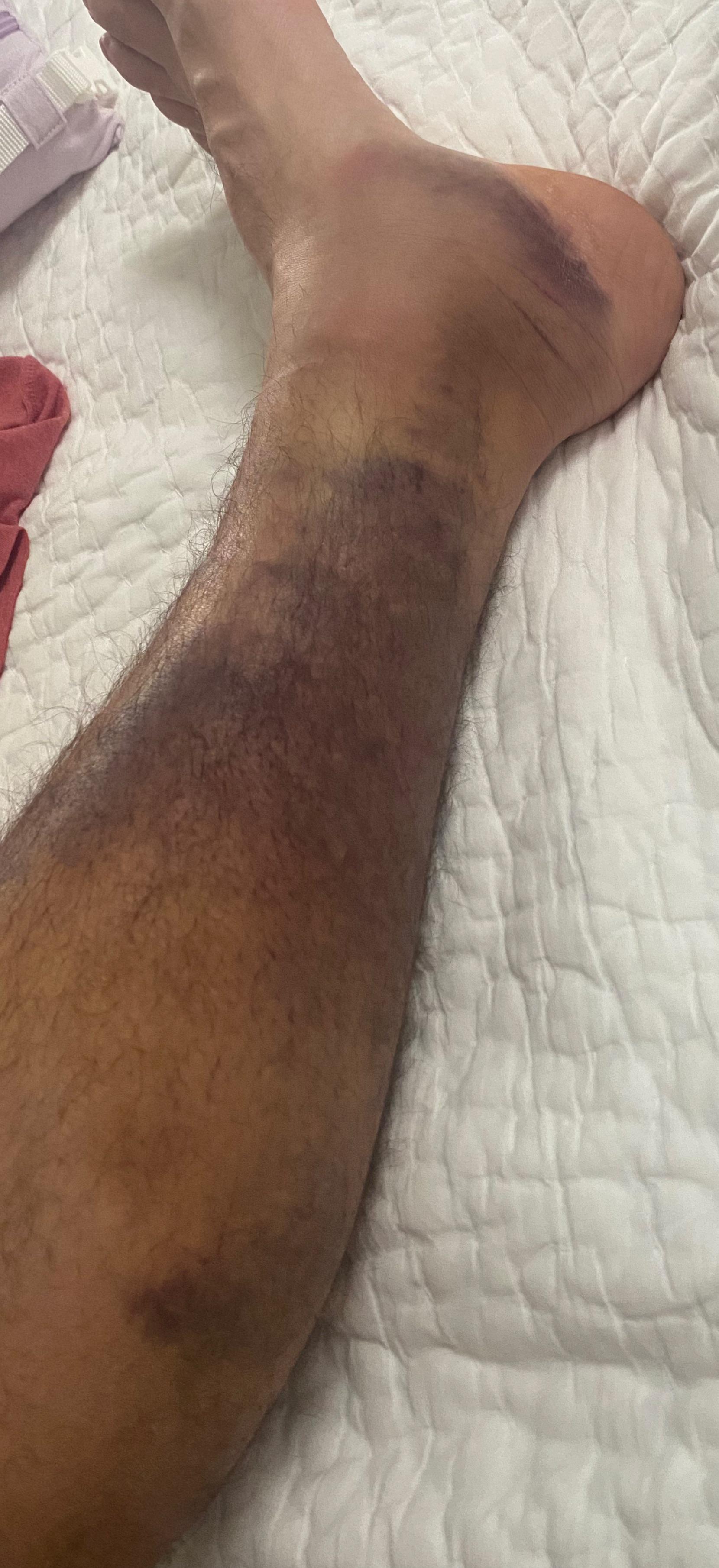 Ruptured my gastroc last week playing r/paintball