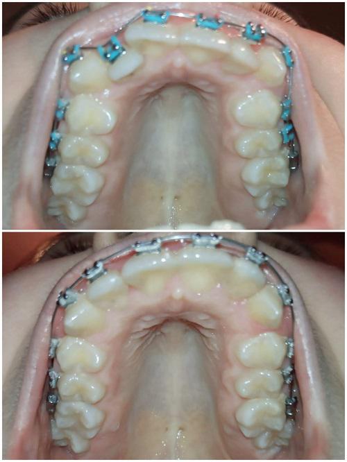 3 months with braces! I just got brackets on my very last molars and