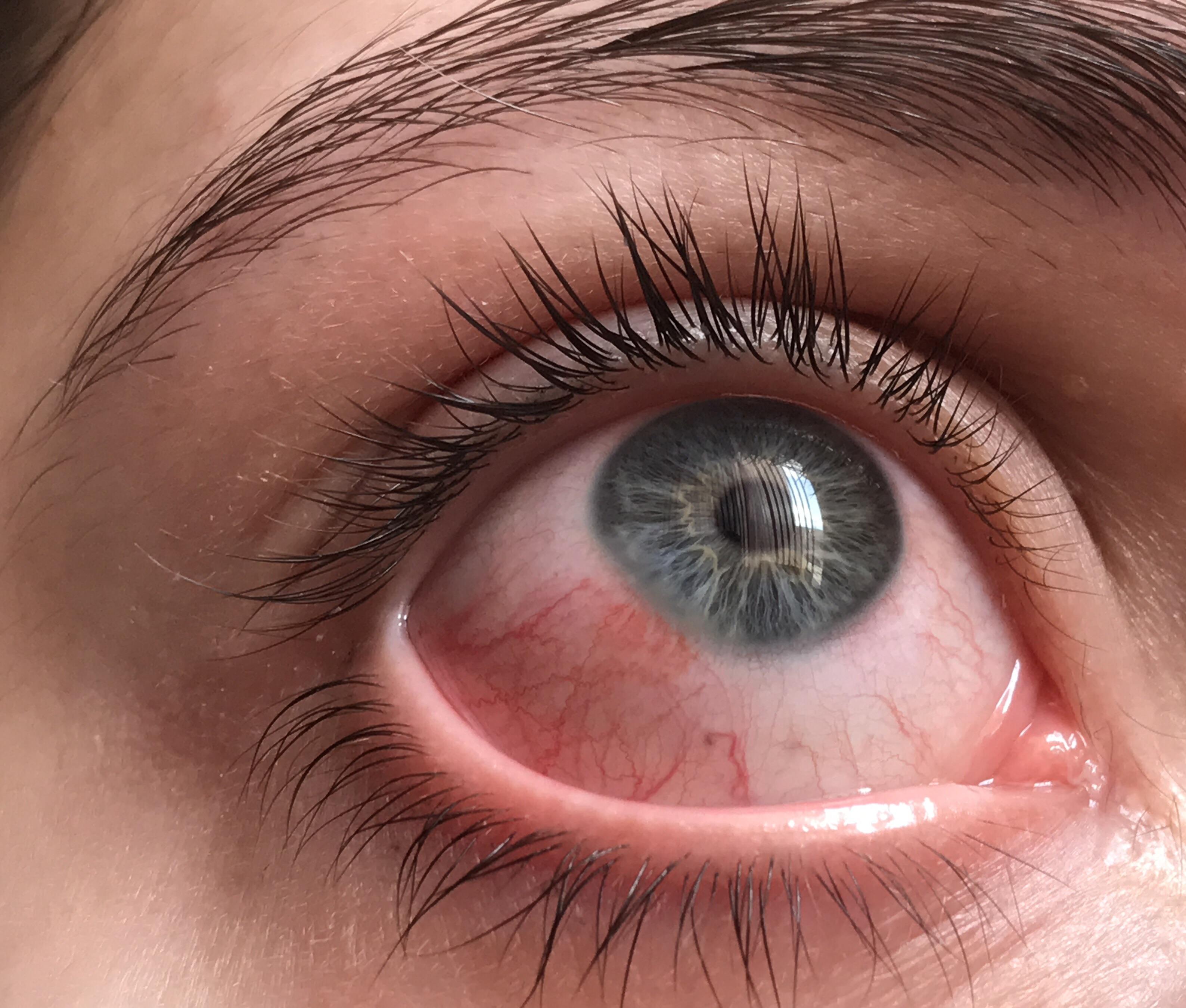 My right eye is SO red and it’s getting so Can anyone