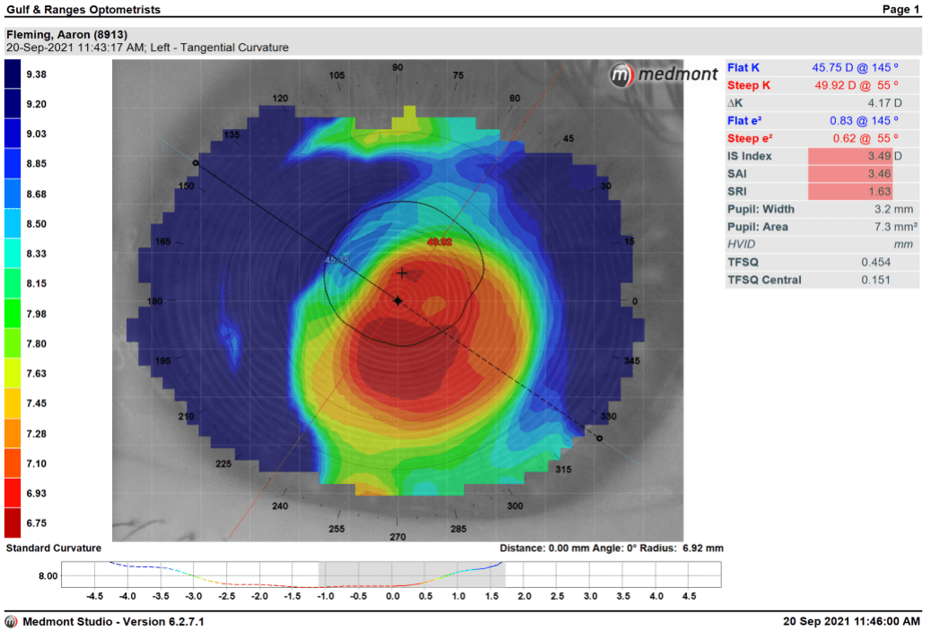 Tips on air bubbles and contact lenses Keratoconus