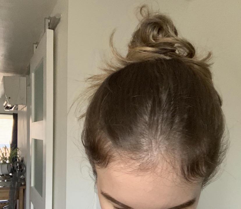 Low iron and hair loss TelogenEffluvium