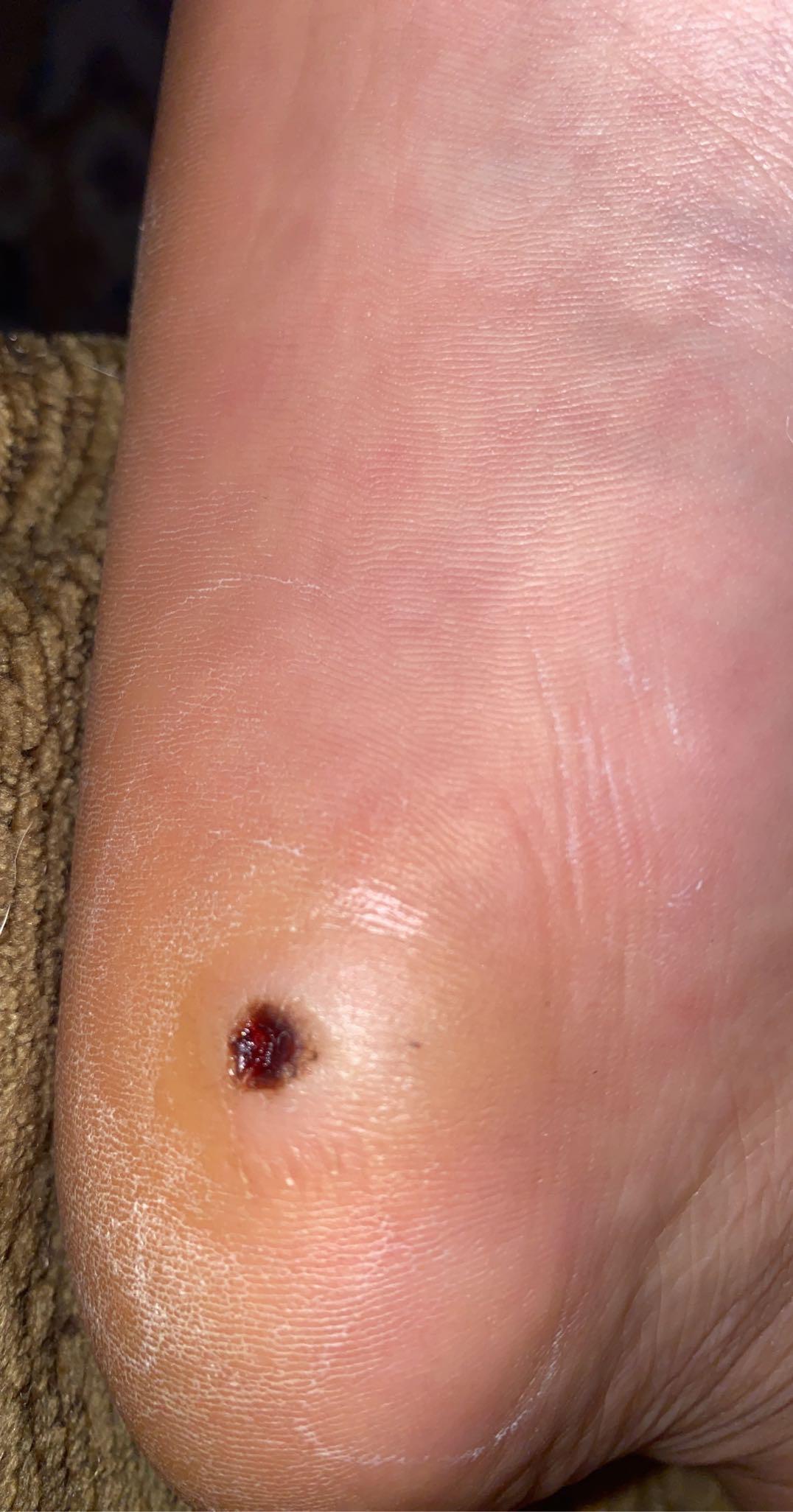 8 days since plantar wart removal it’s so hard to walk bc it is on my