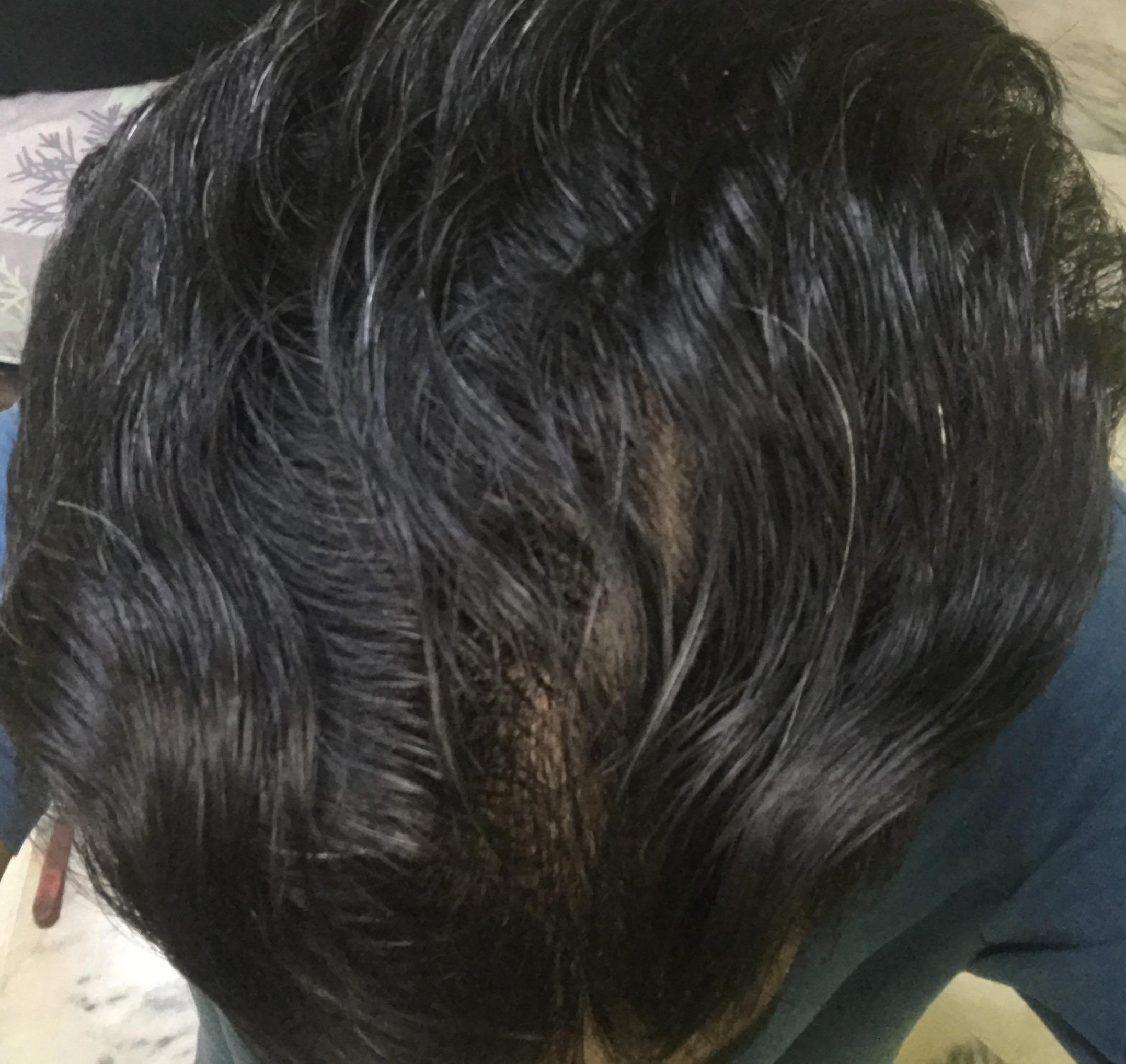 Diffuse thinning right? Hairloss