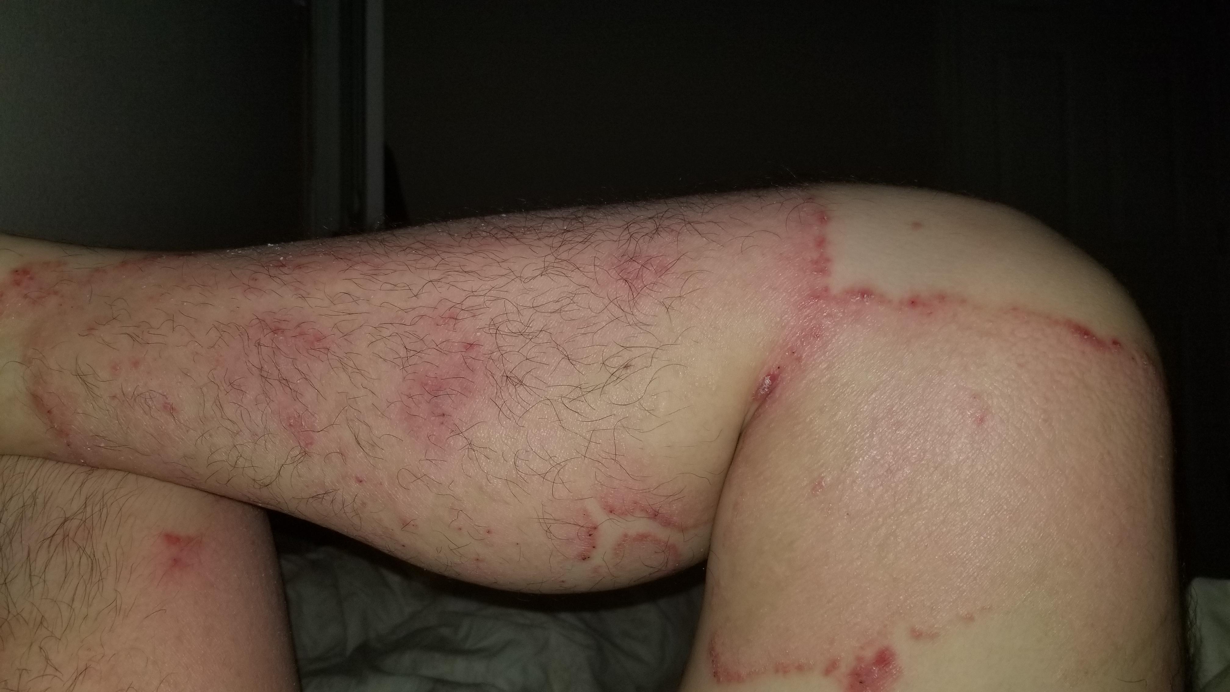 Weird. Ive been having terrible stomach pain after a burger few days