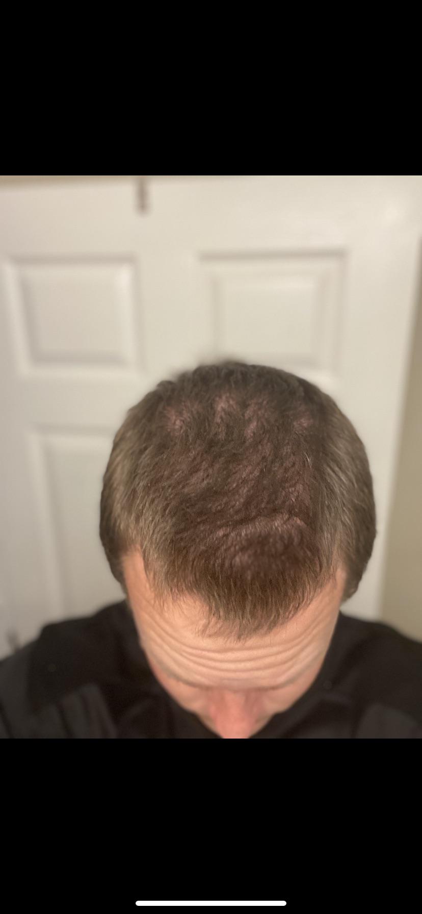 I’m 23… is my hair thinning? r/Hair