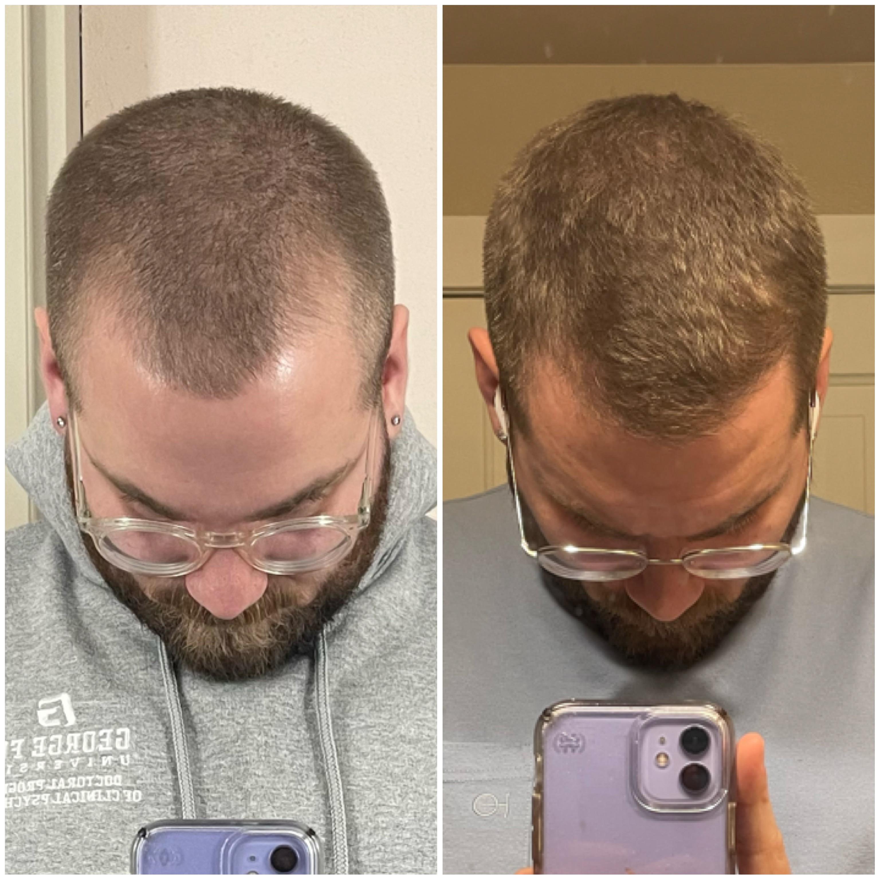 9 months on Hims minoxidil & finasteride spray. Happy with the results