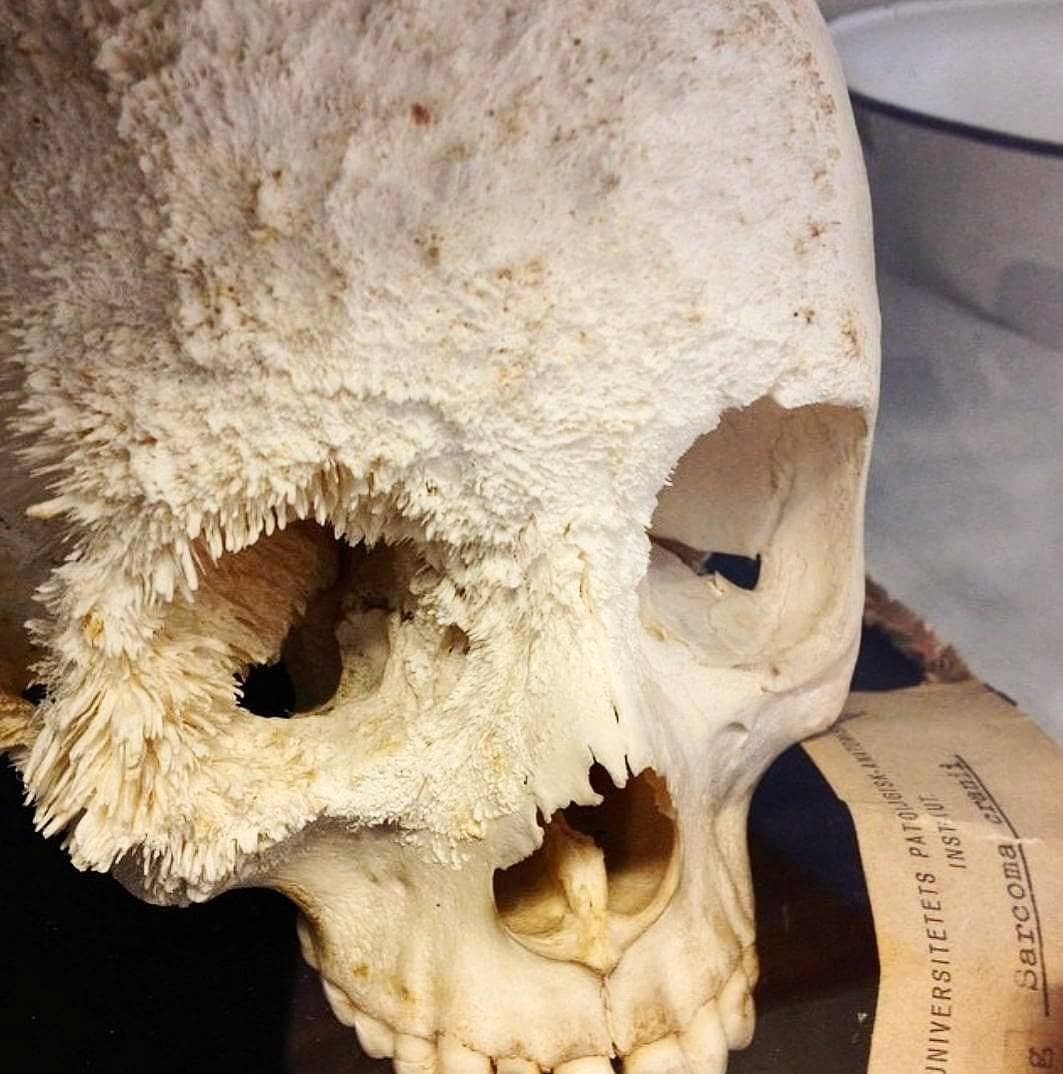 Bone cancer... Damnthatsinteresting