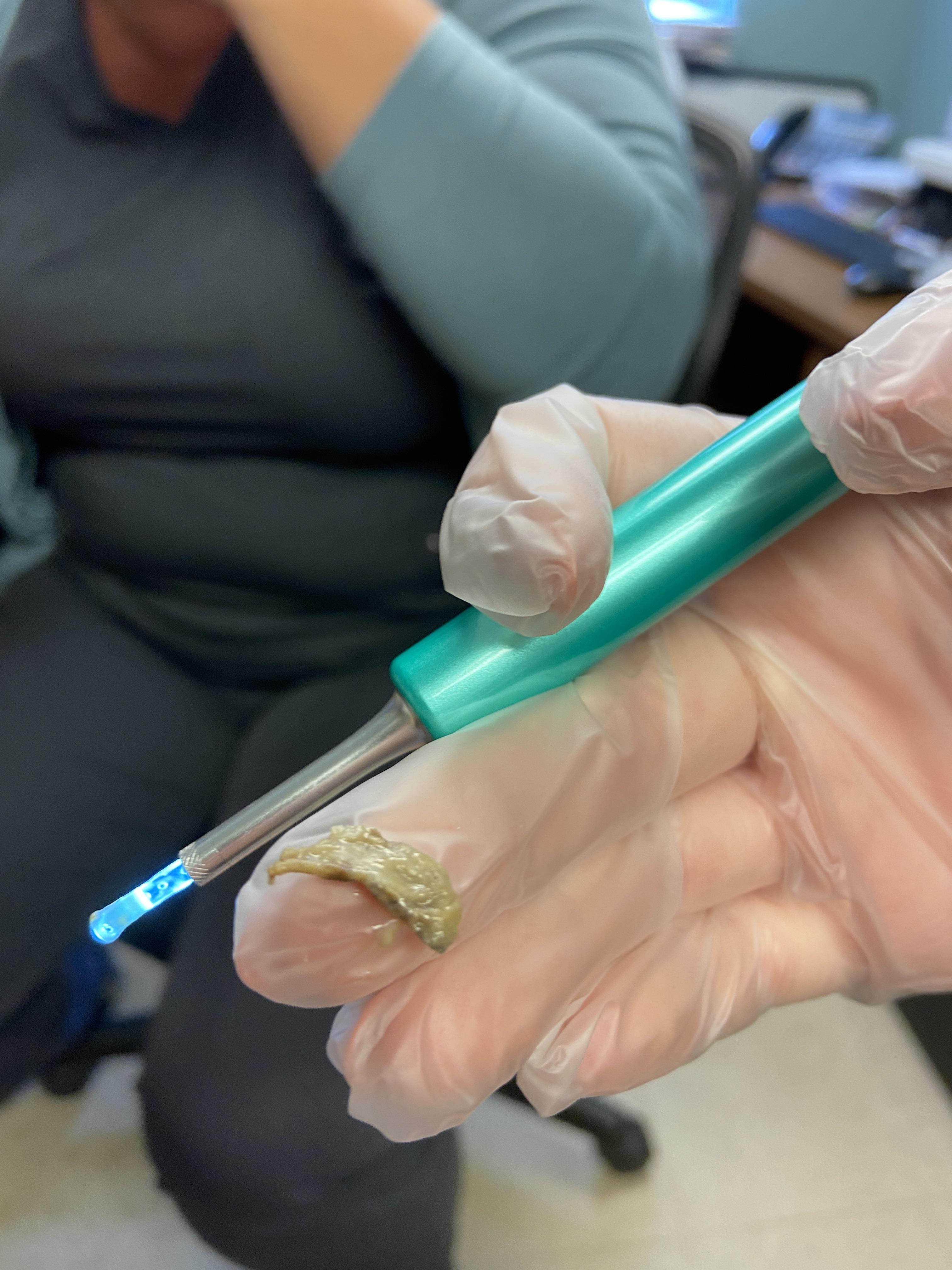 After 2.5 weeks of a blocked ear, using ear wax removal drops and a