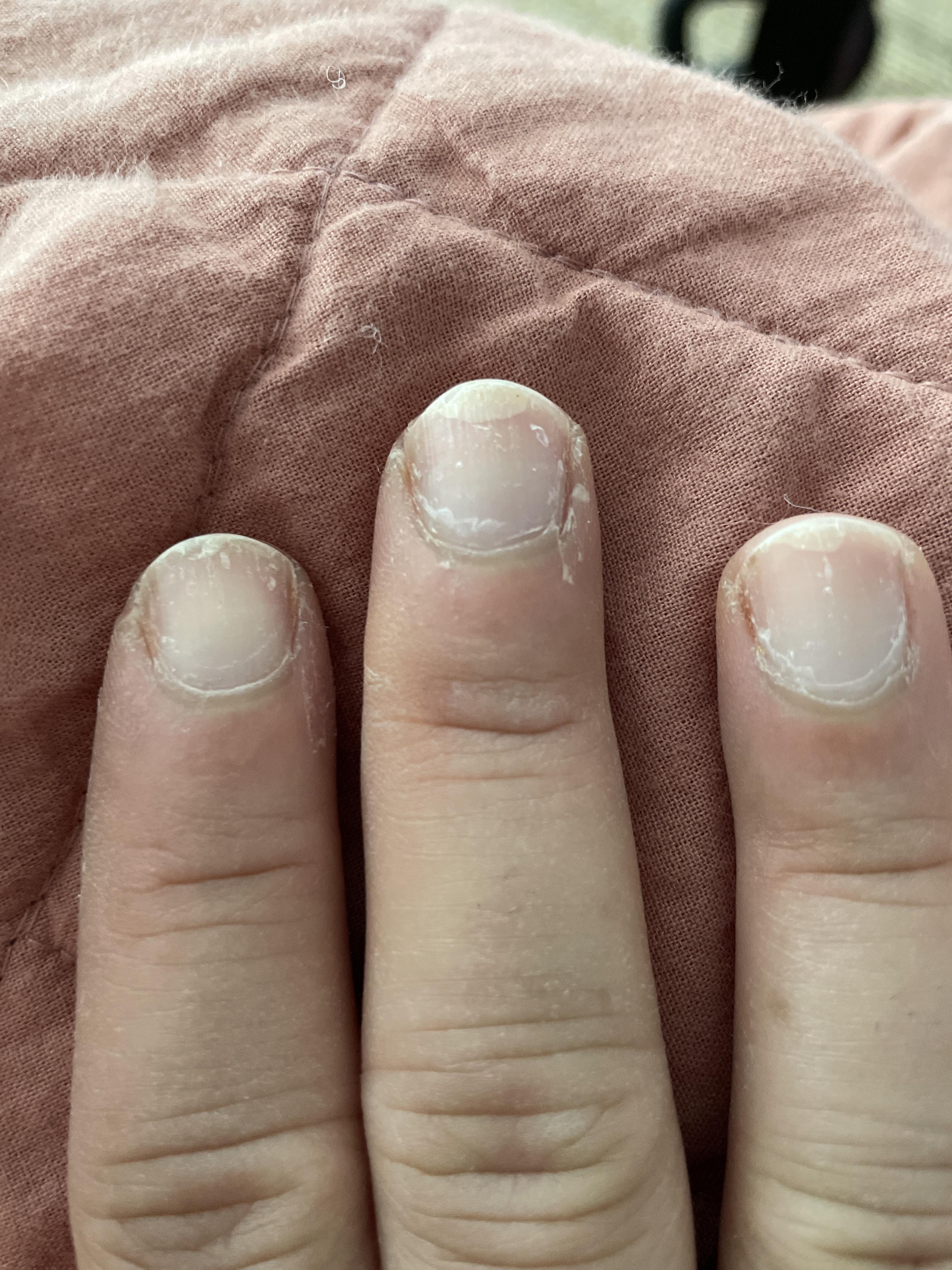 I love having my nails painted, but this doesn’t look healthy. Advice