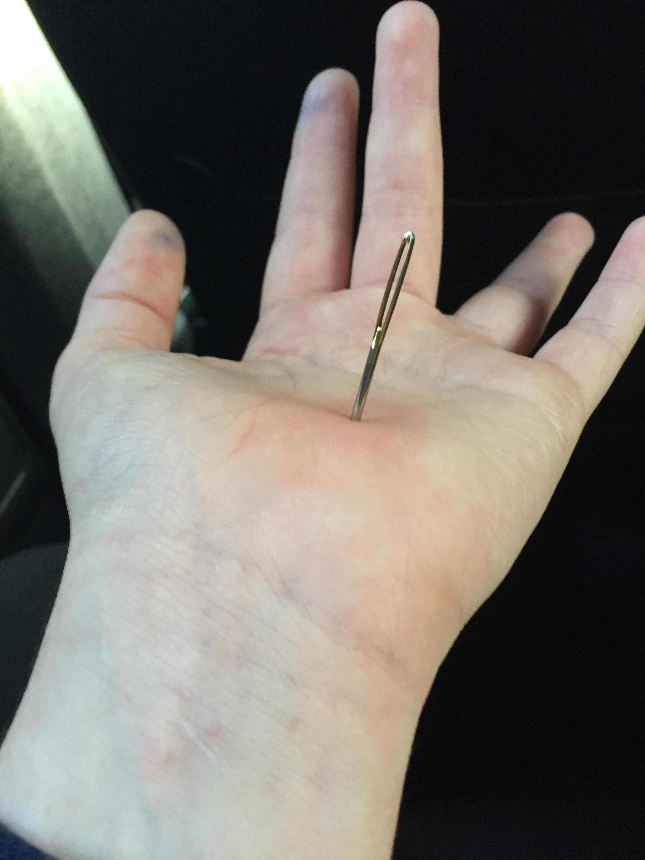 6 inch sewing needle that pinned the tendon in my finger r/HadToHurt