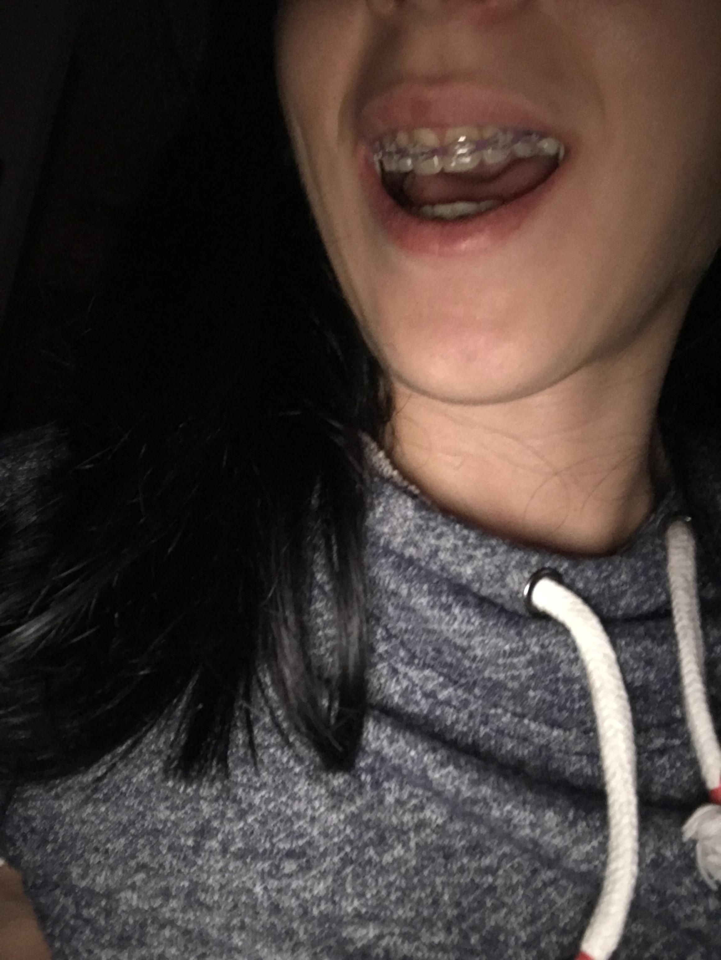 First adjustment holy crap r/braces