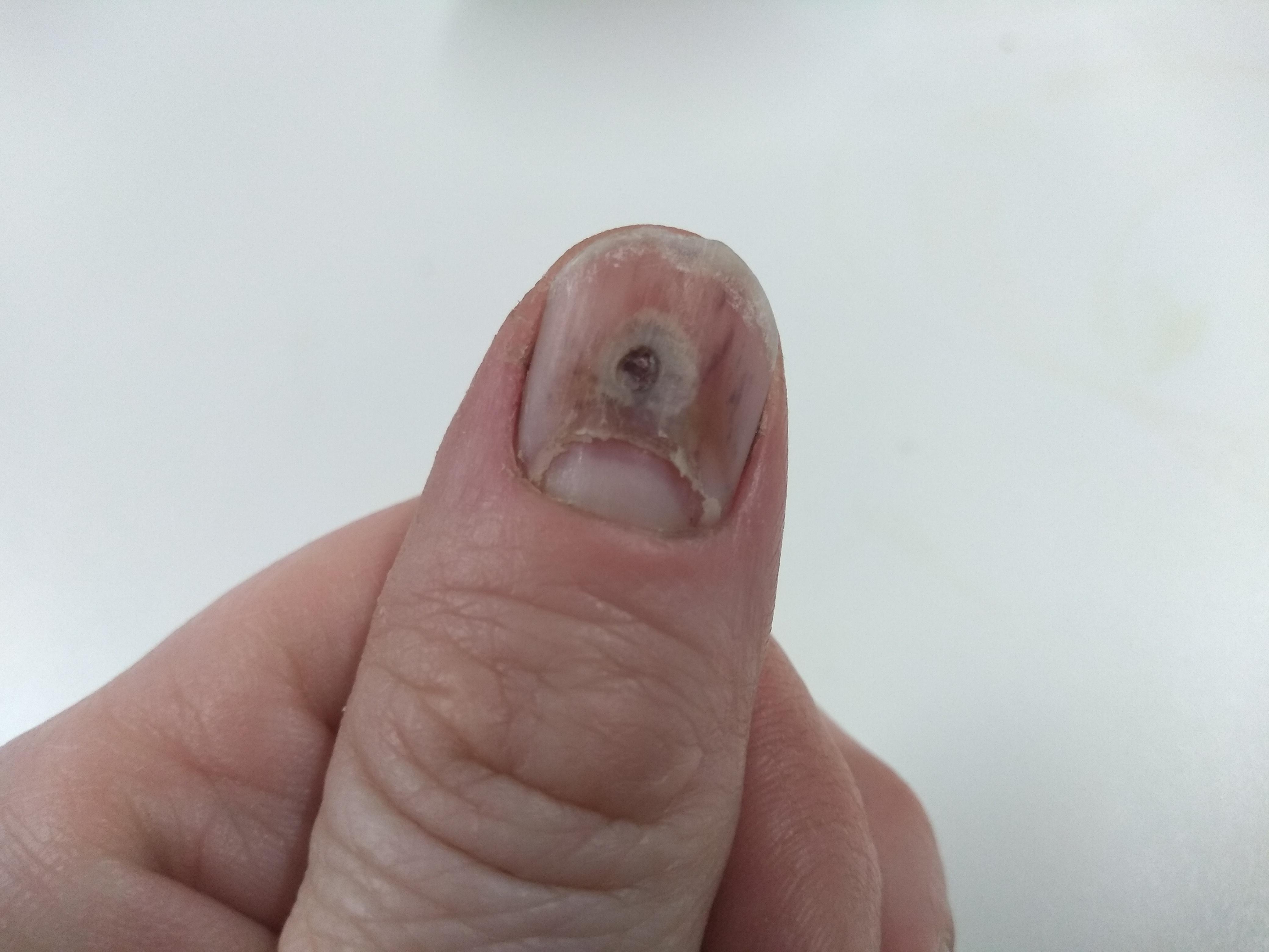 I trapped my finger a while ago and had to drill a hole in the nail to