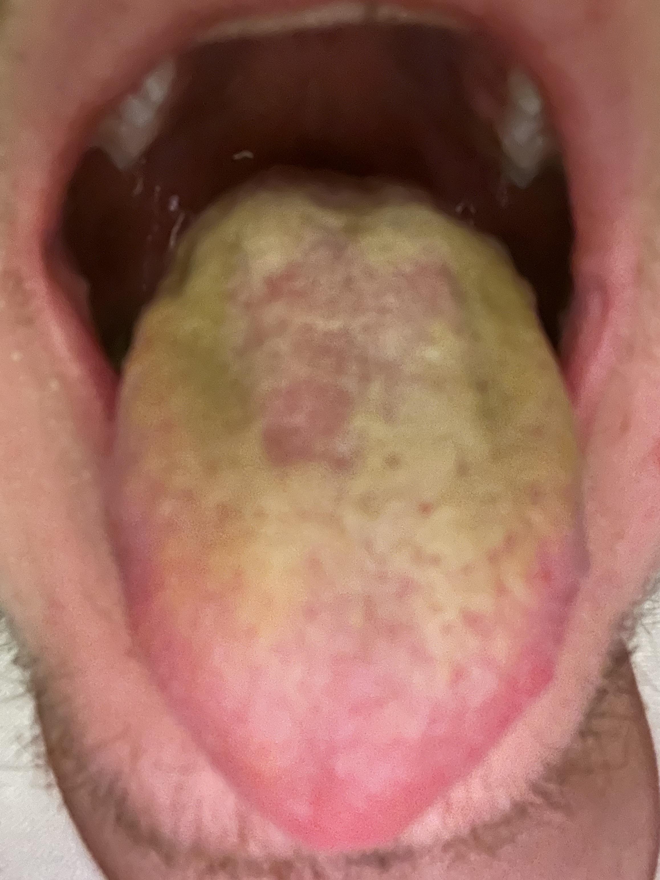 Tongue has been this way for a month. Have been on two different