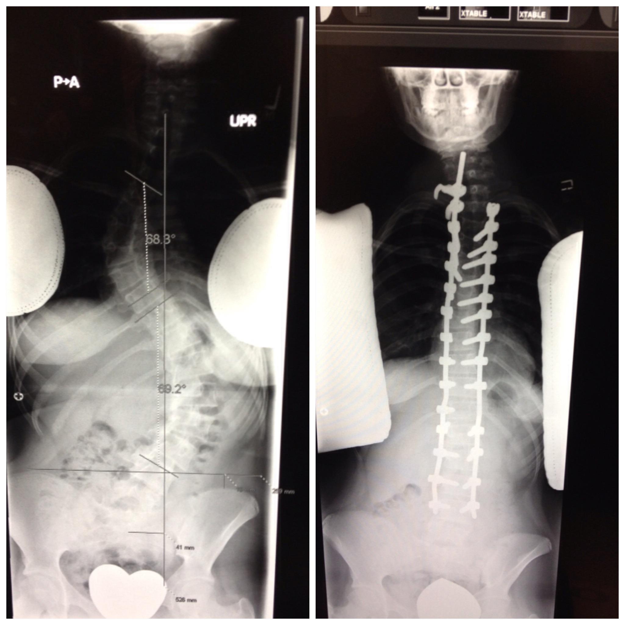I had a complete Posterior Spinal Fusion in December 2012 to fix my severe scoliosis and grew 4