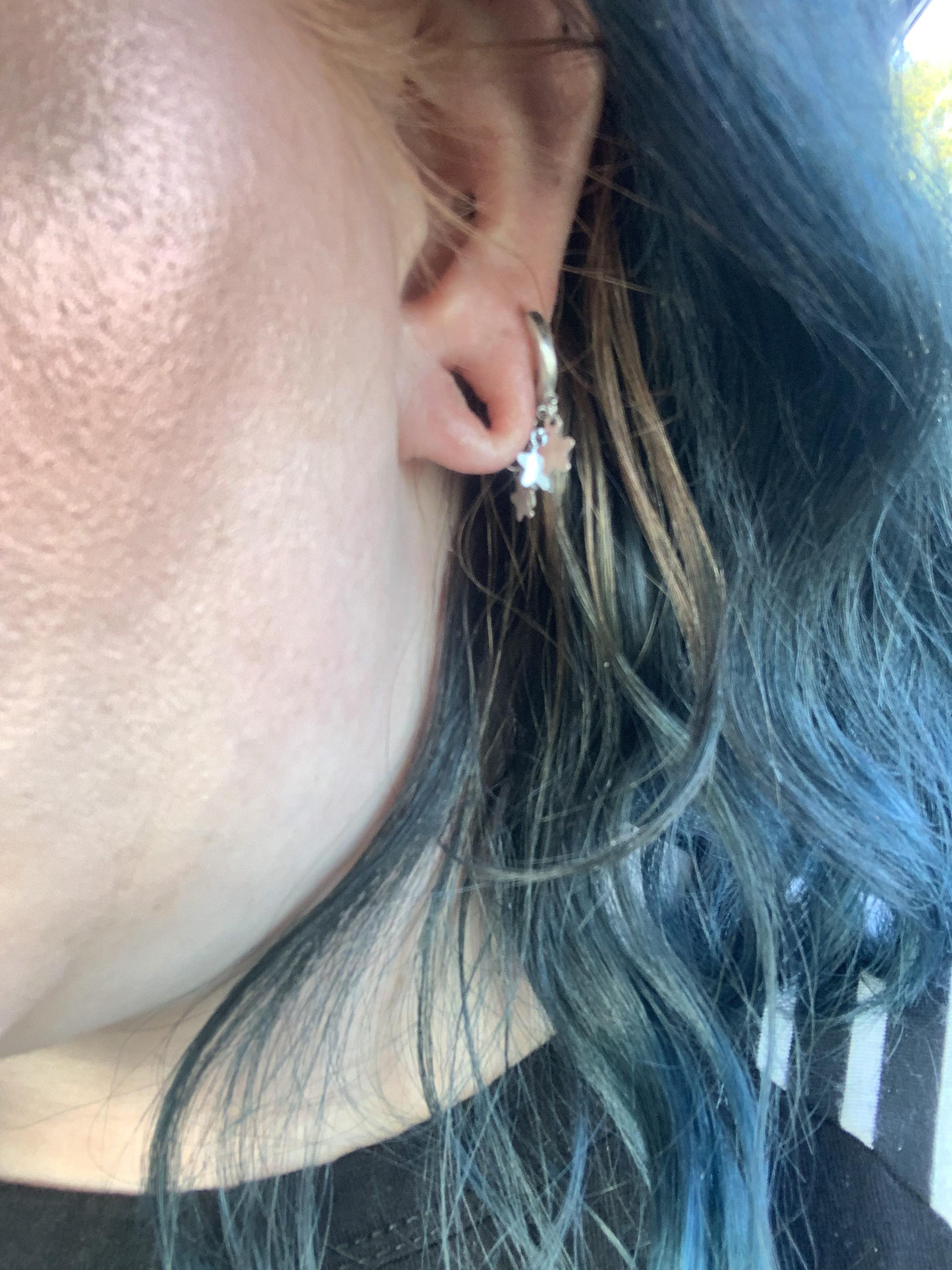 I had an allergic reaction to some acrylic plugs and now my lobes are