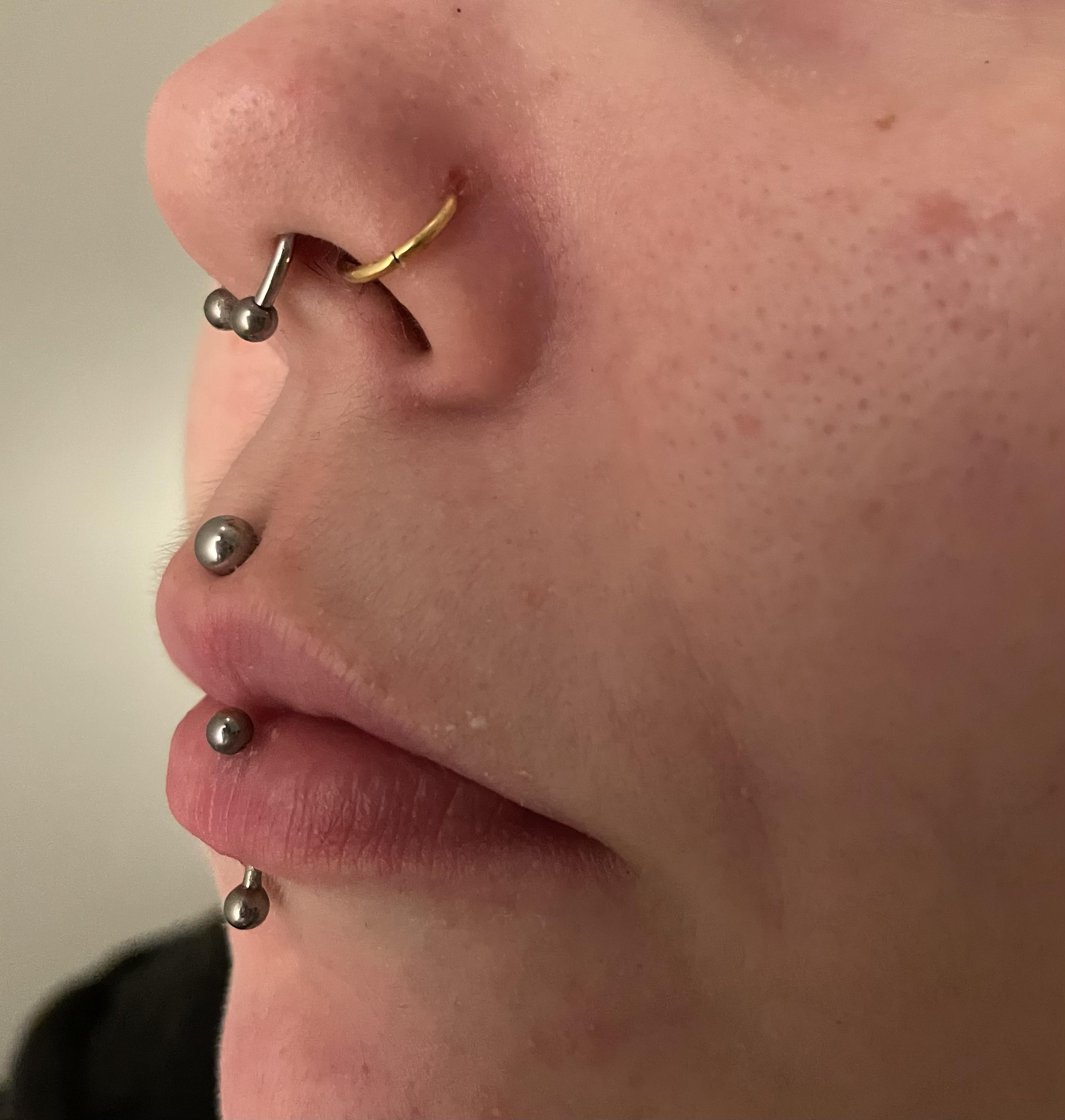 Switched to hoop in nostril and it became a irritation bump and now